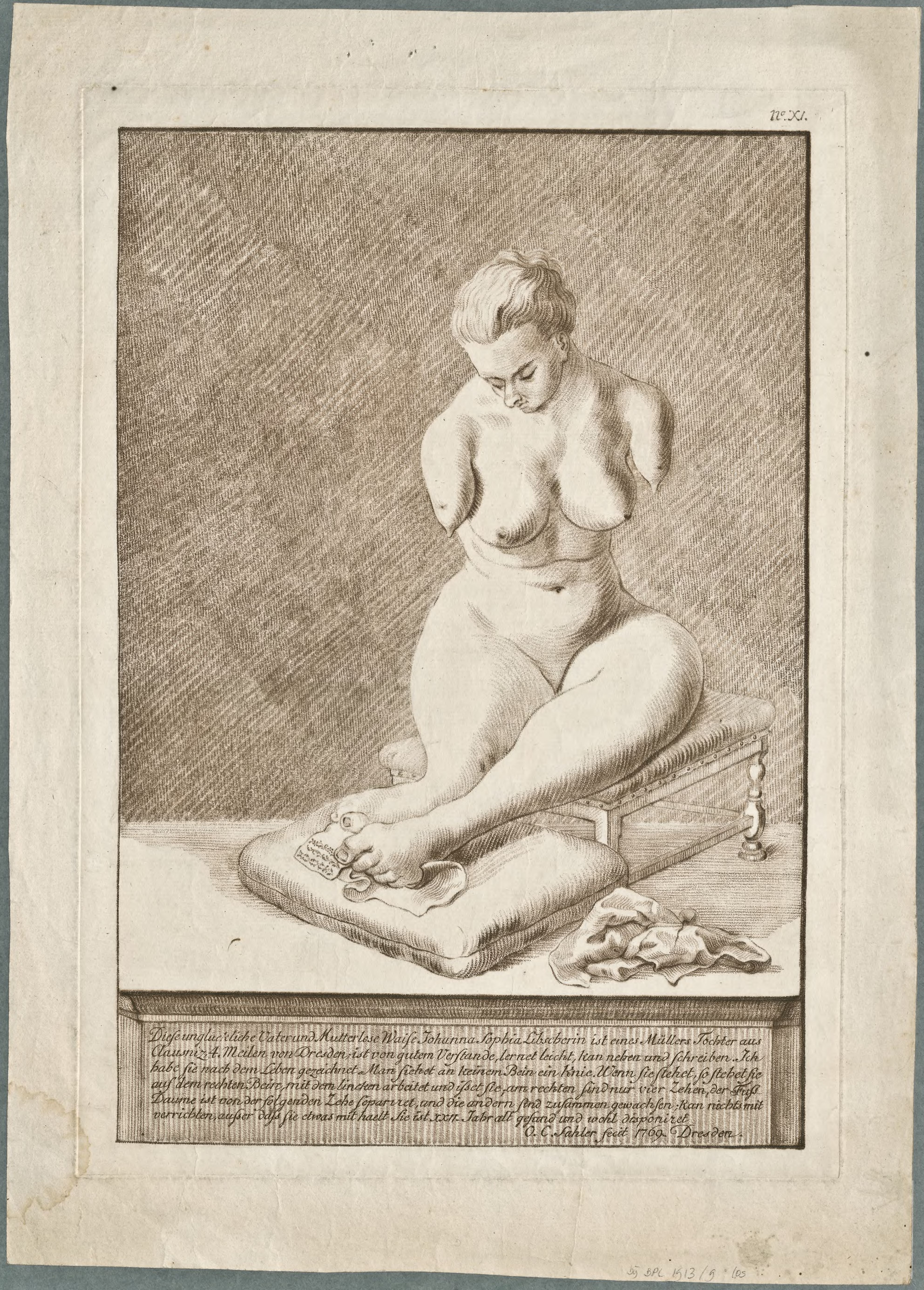 Anatomical drawings: portrait of Johanna Sophia Libscherin, born without arms, and knees, with unequal legs