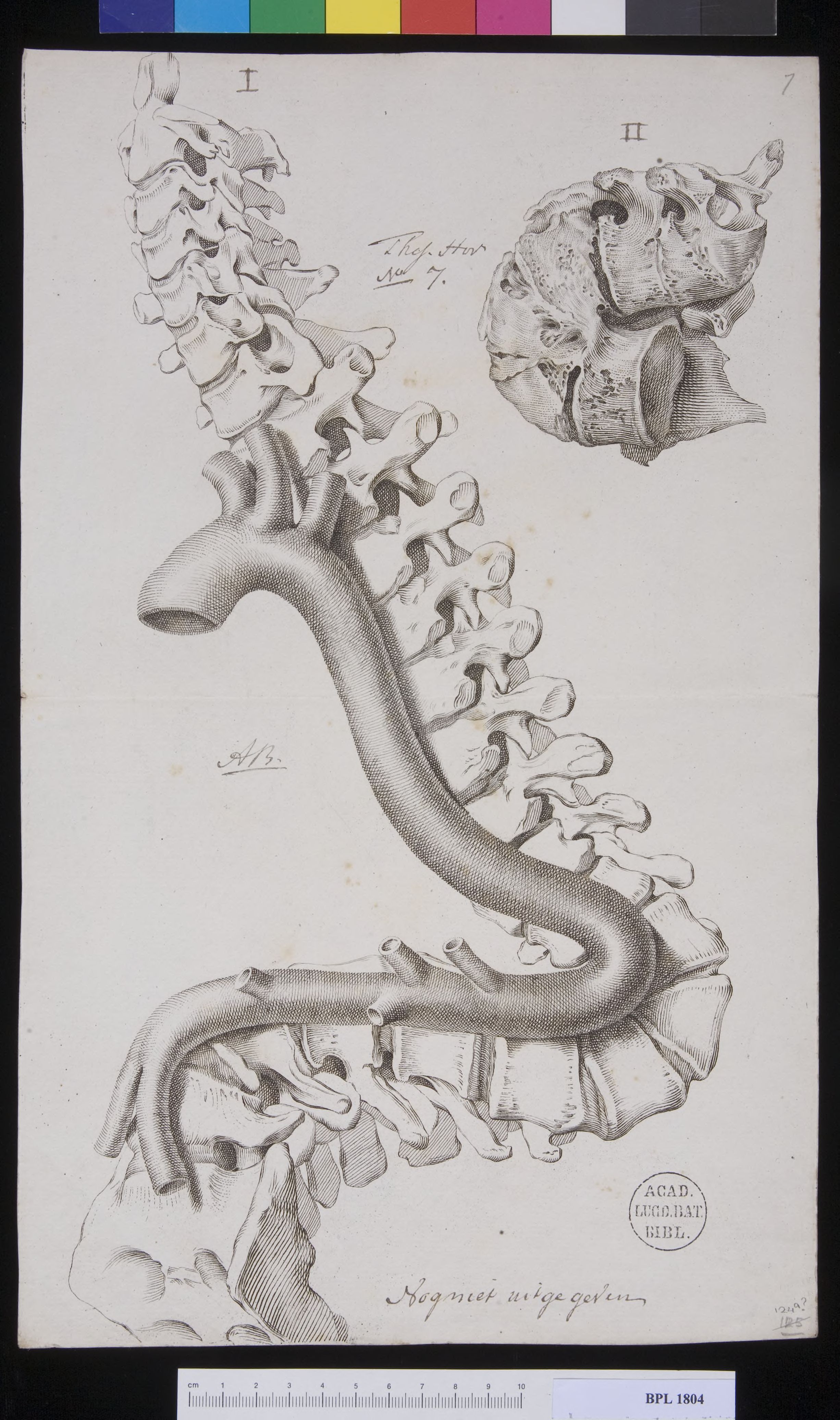 Spine with severe scoliosis and aorta