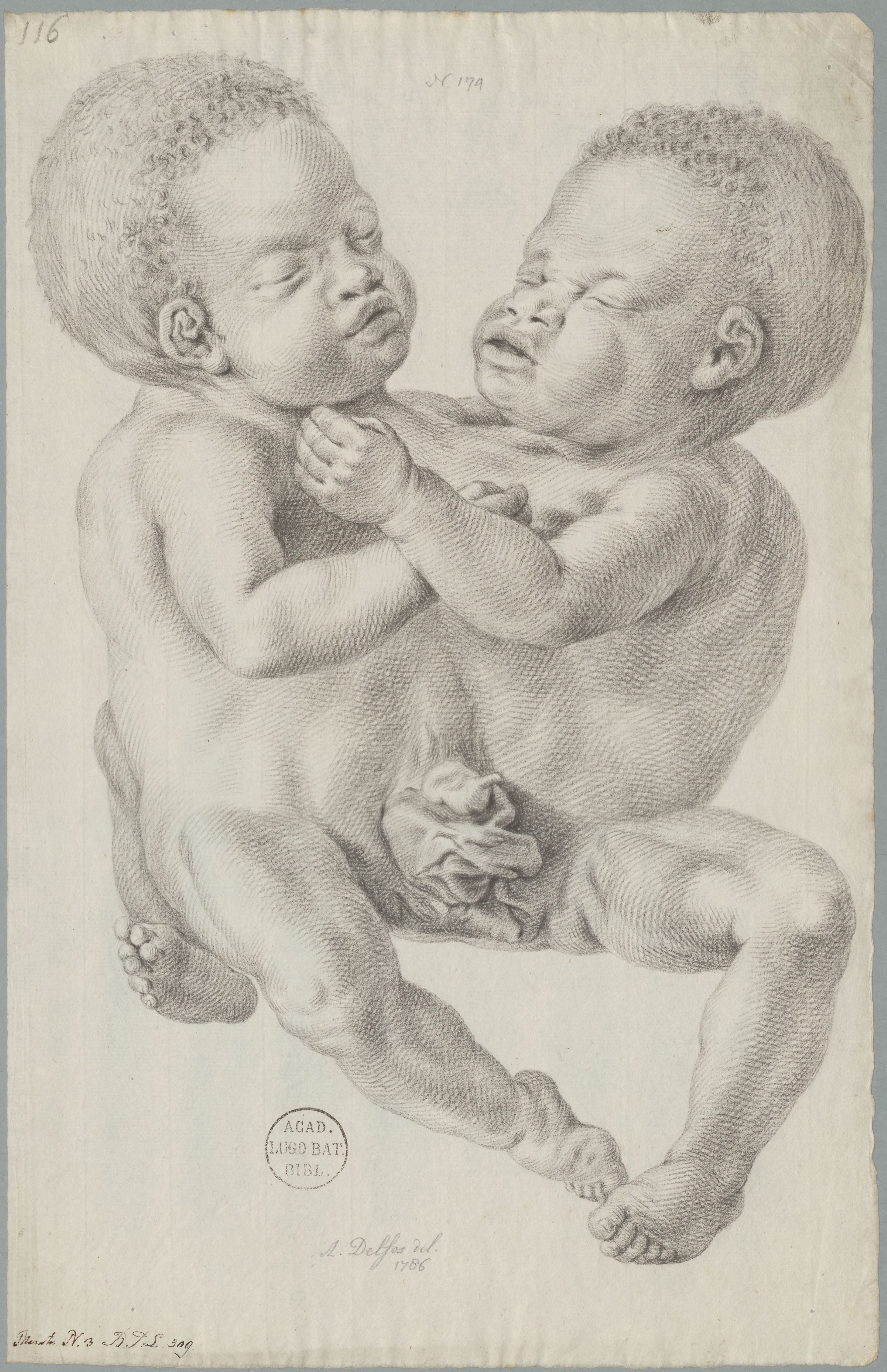 Conjoined (Siamese) twins