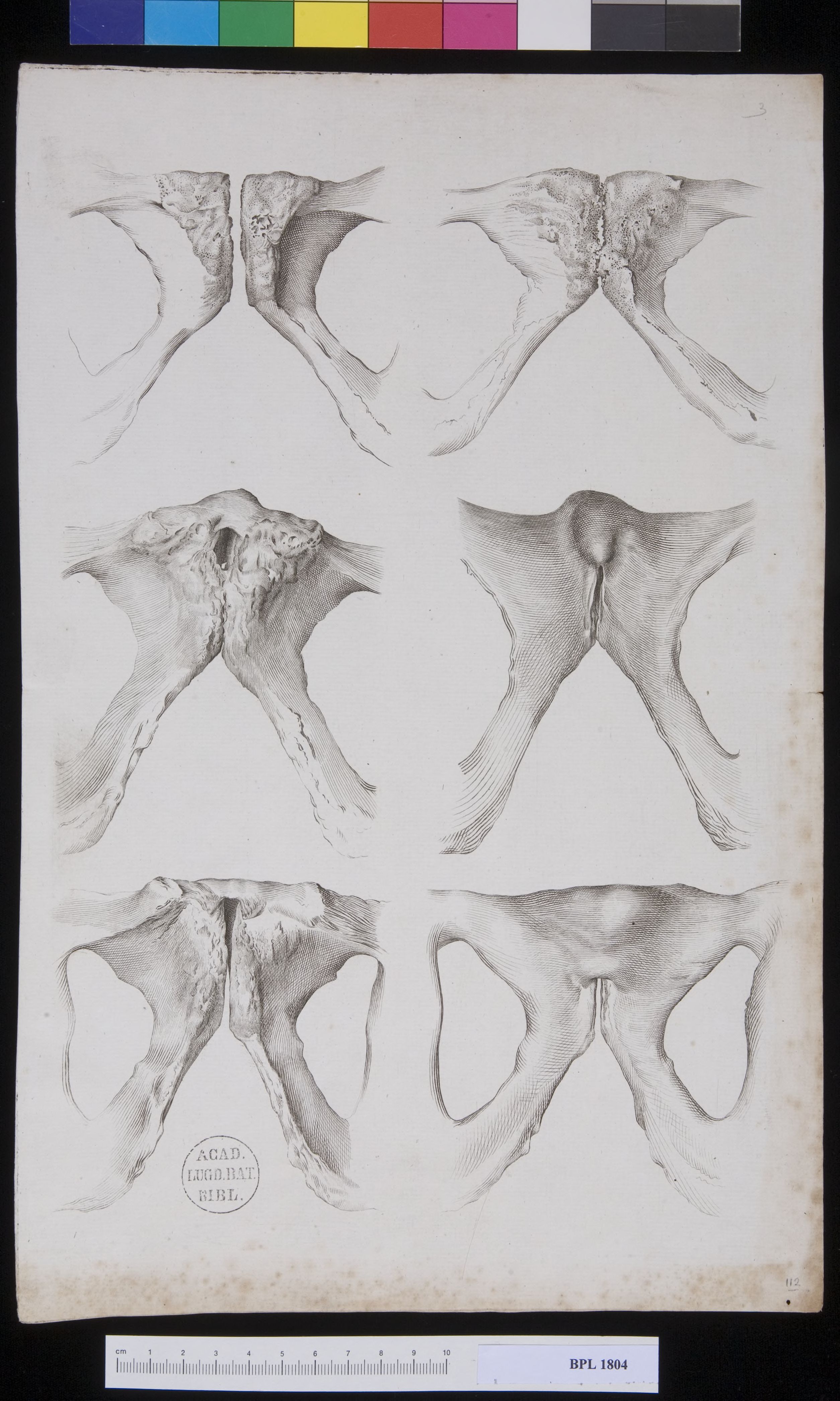 Pathology, fractures (Pelvis, female pubis)