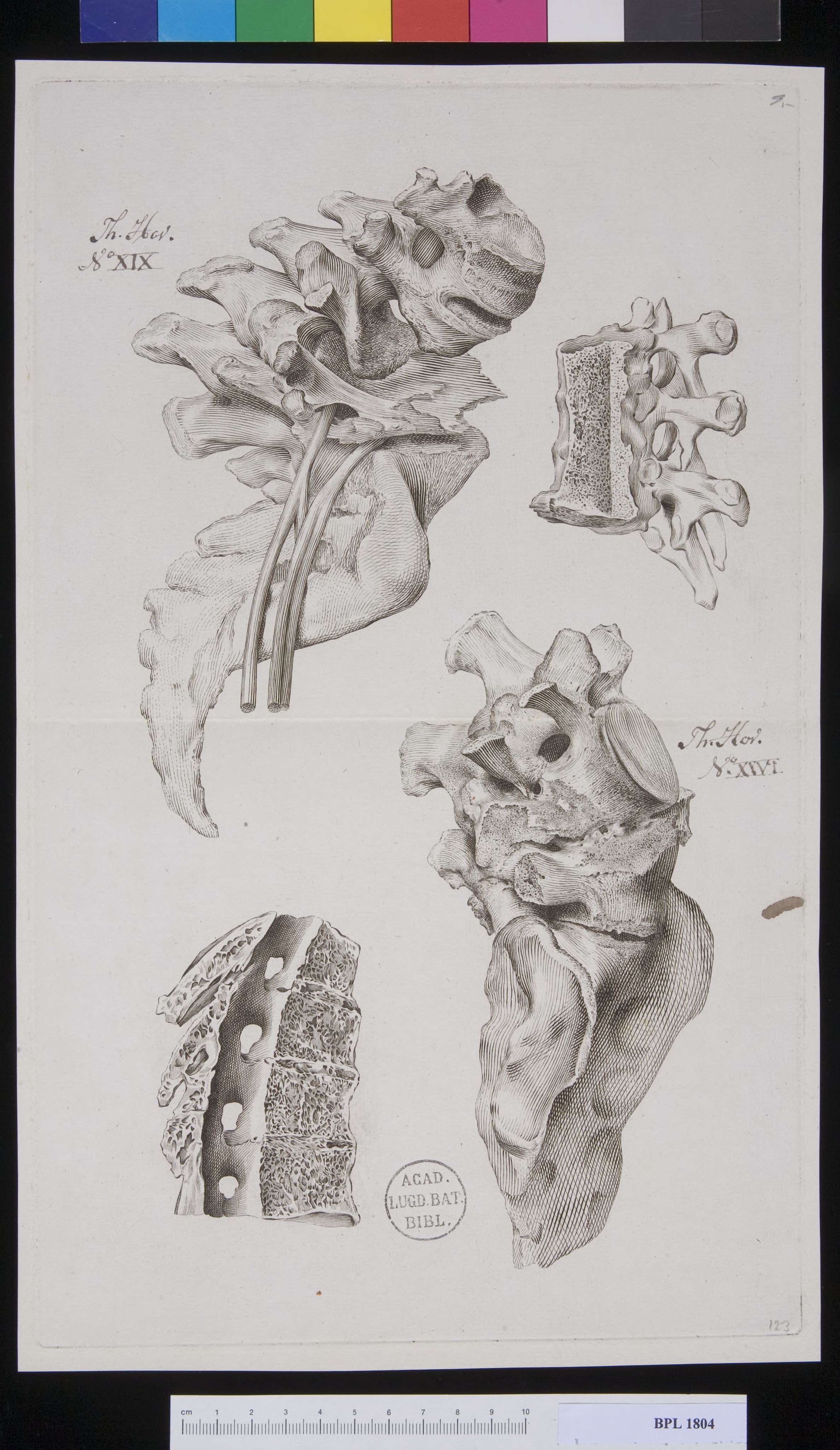 Pathology, fractures (Spine, cervical vertebrae)