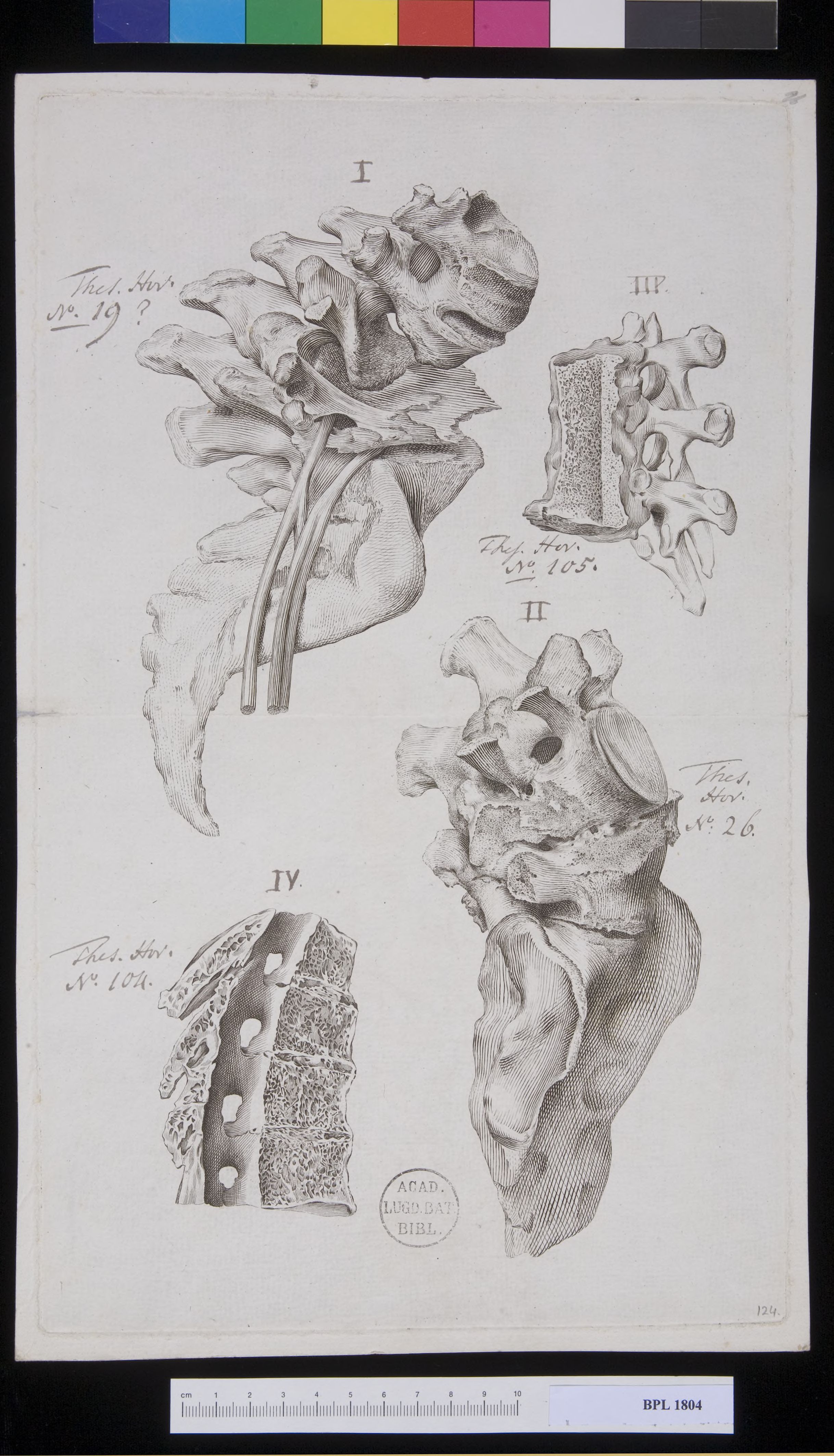 Pathology, fractures (Spine, cervical vertebrae)
