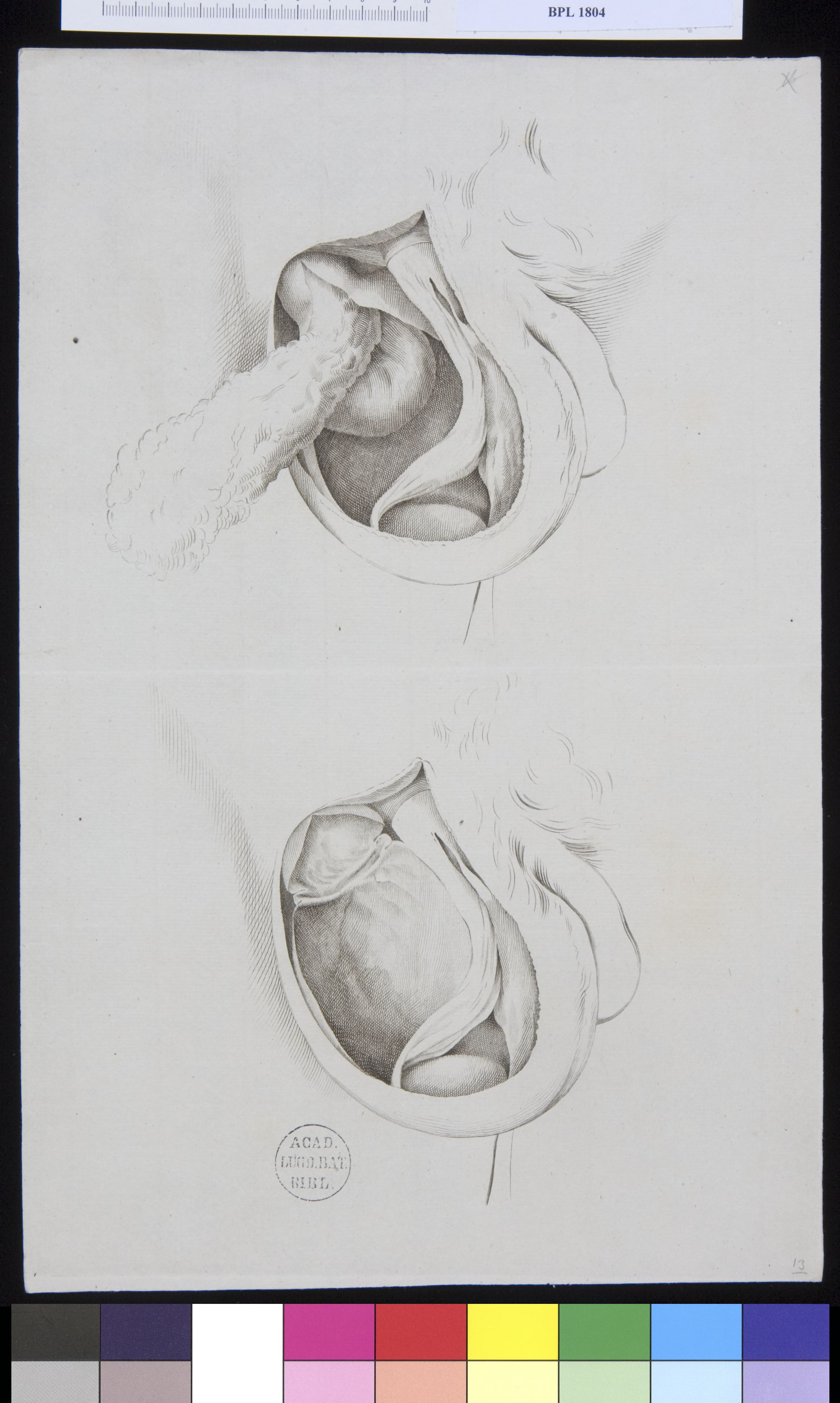 Pathology, fractures (testicles)