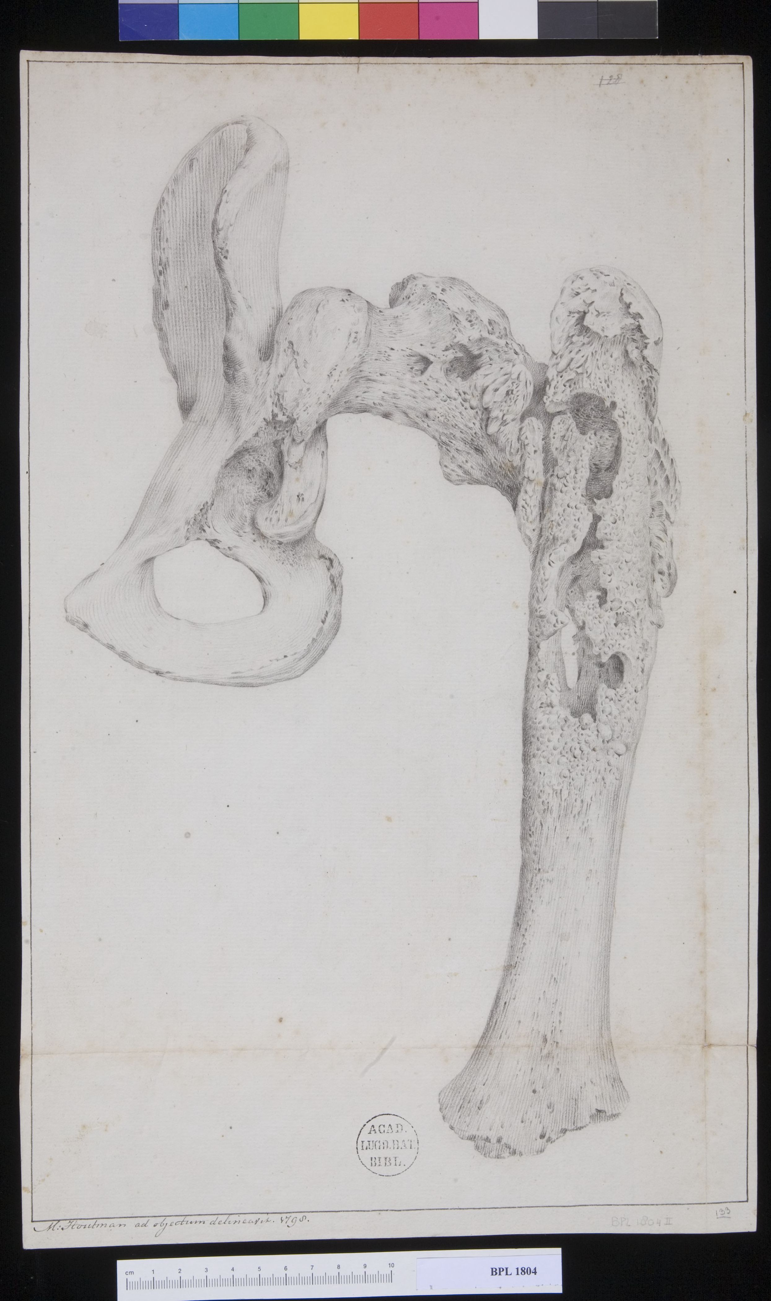Pathology, fractures (Upper femur)