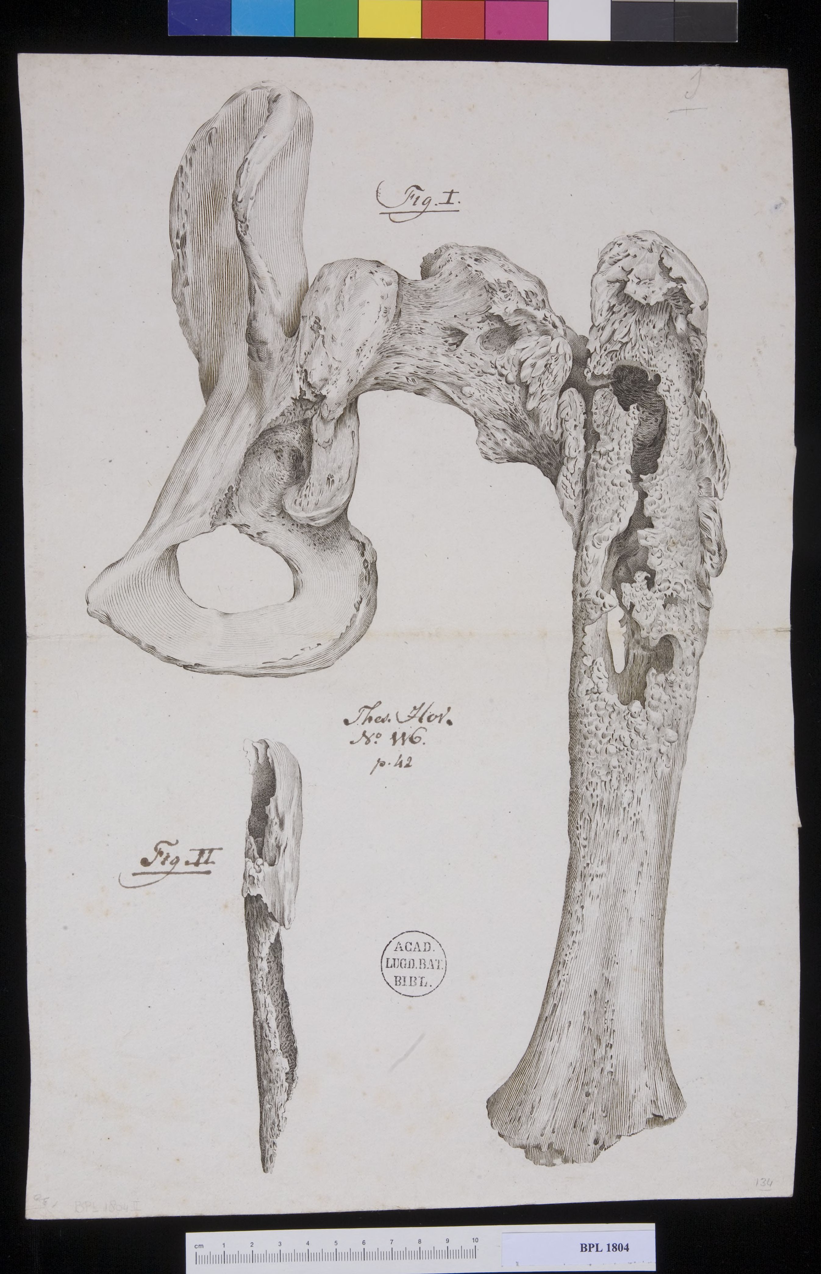 Pathology, fractures (Upper femur)