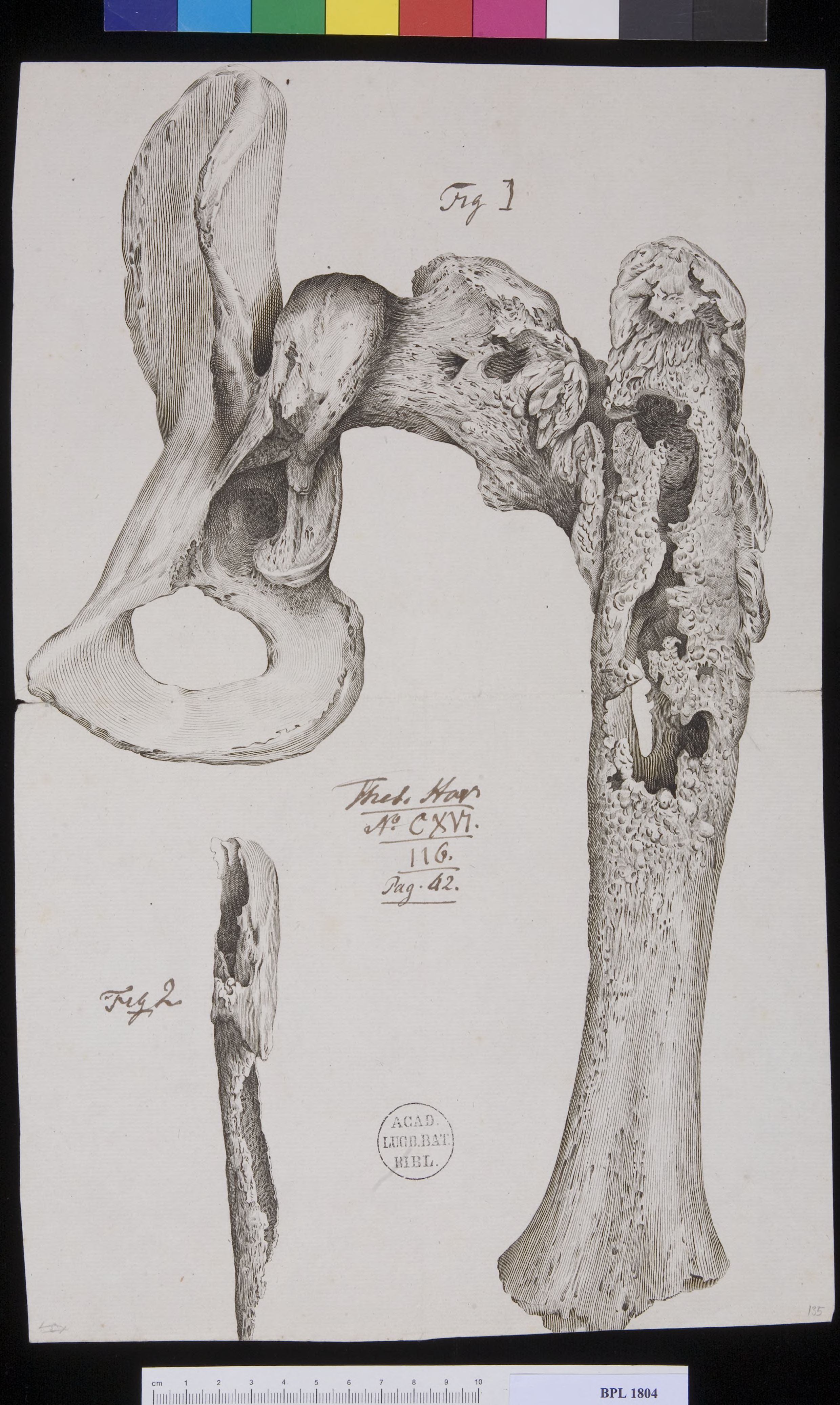 Pathology, fractures (Upper femur)