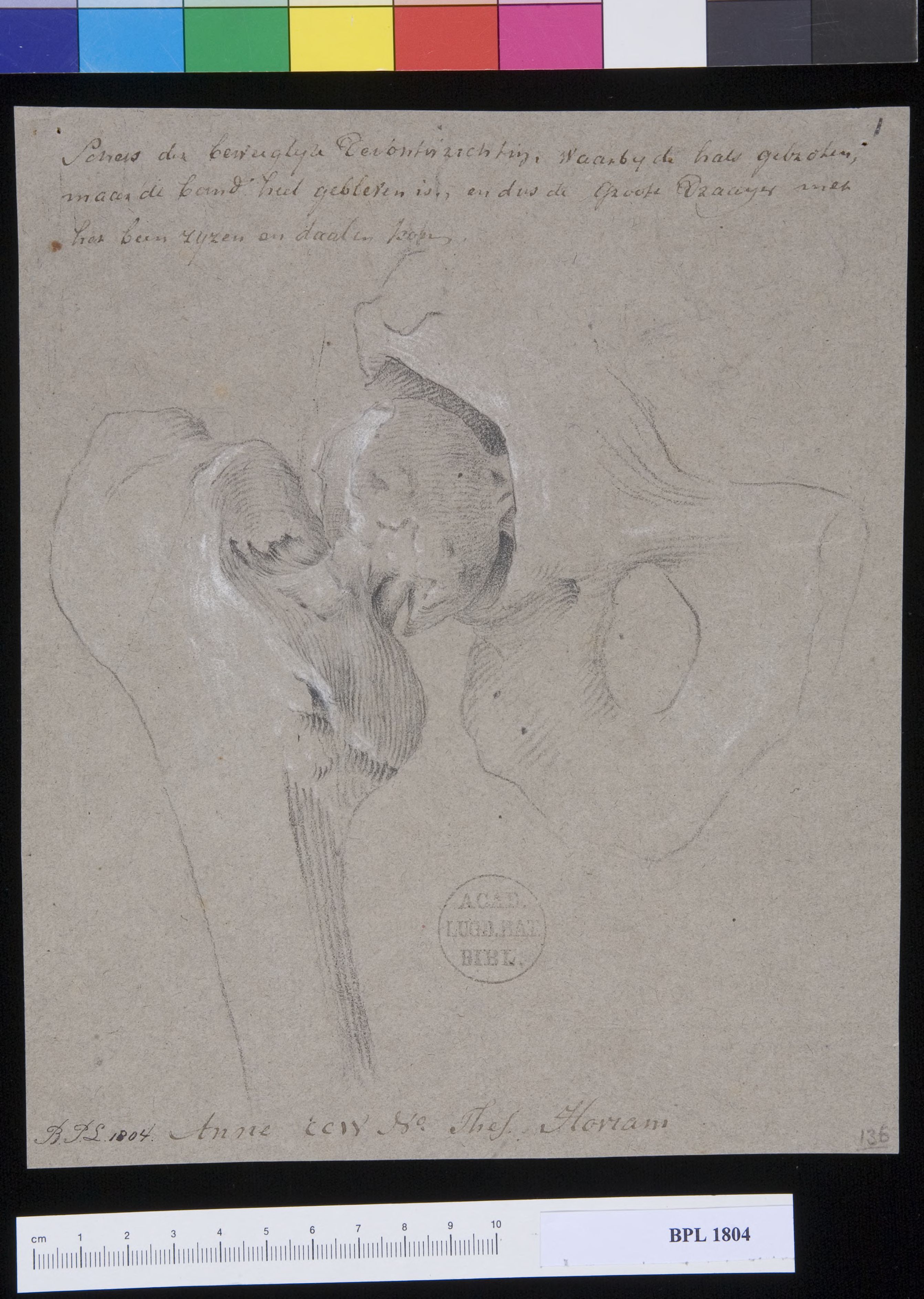 Pathology, fractures (Broken femoral head)