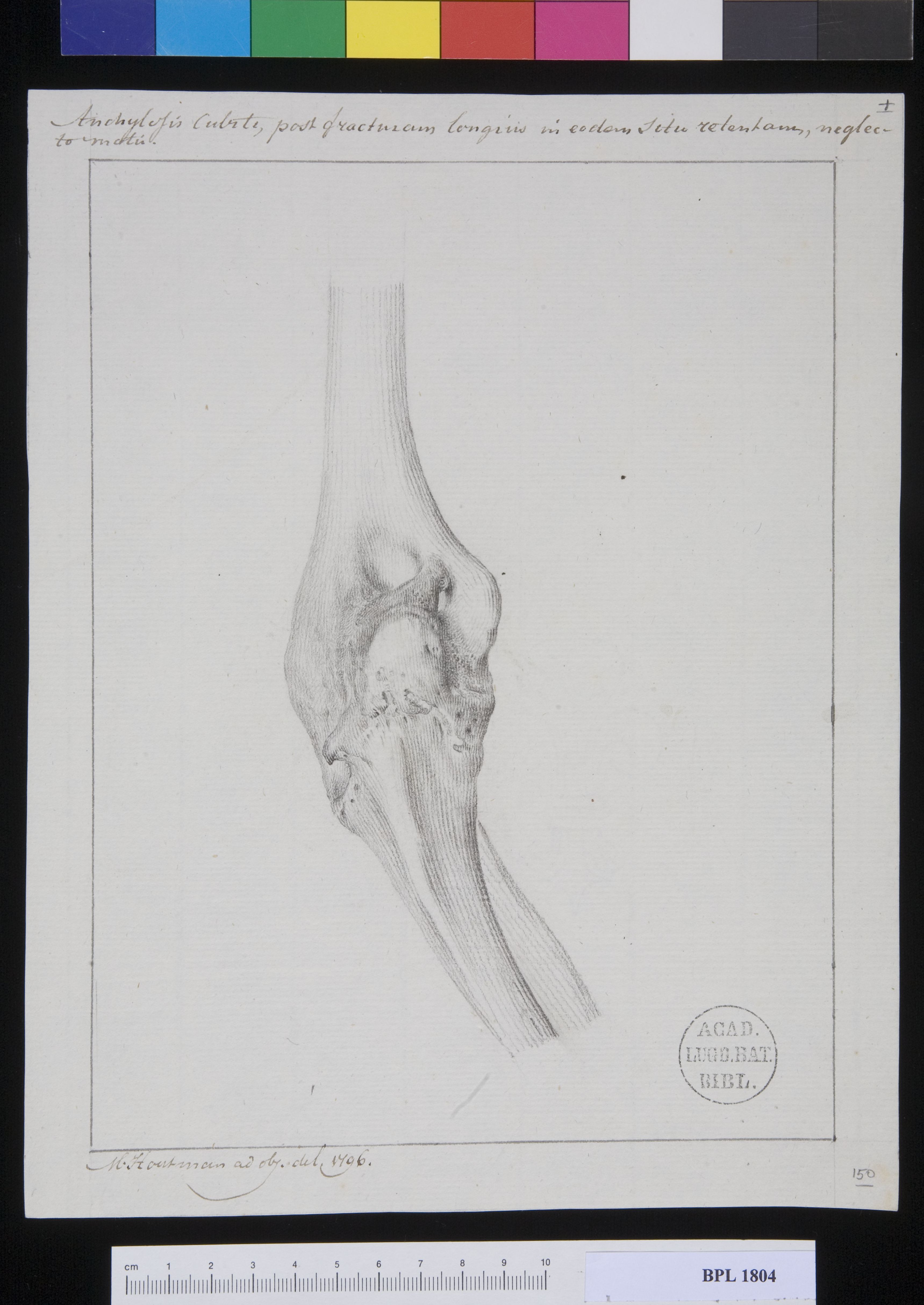 Pathology, fractures (Ankylosis)