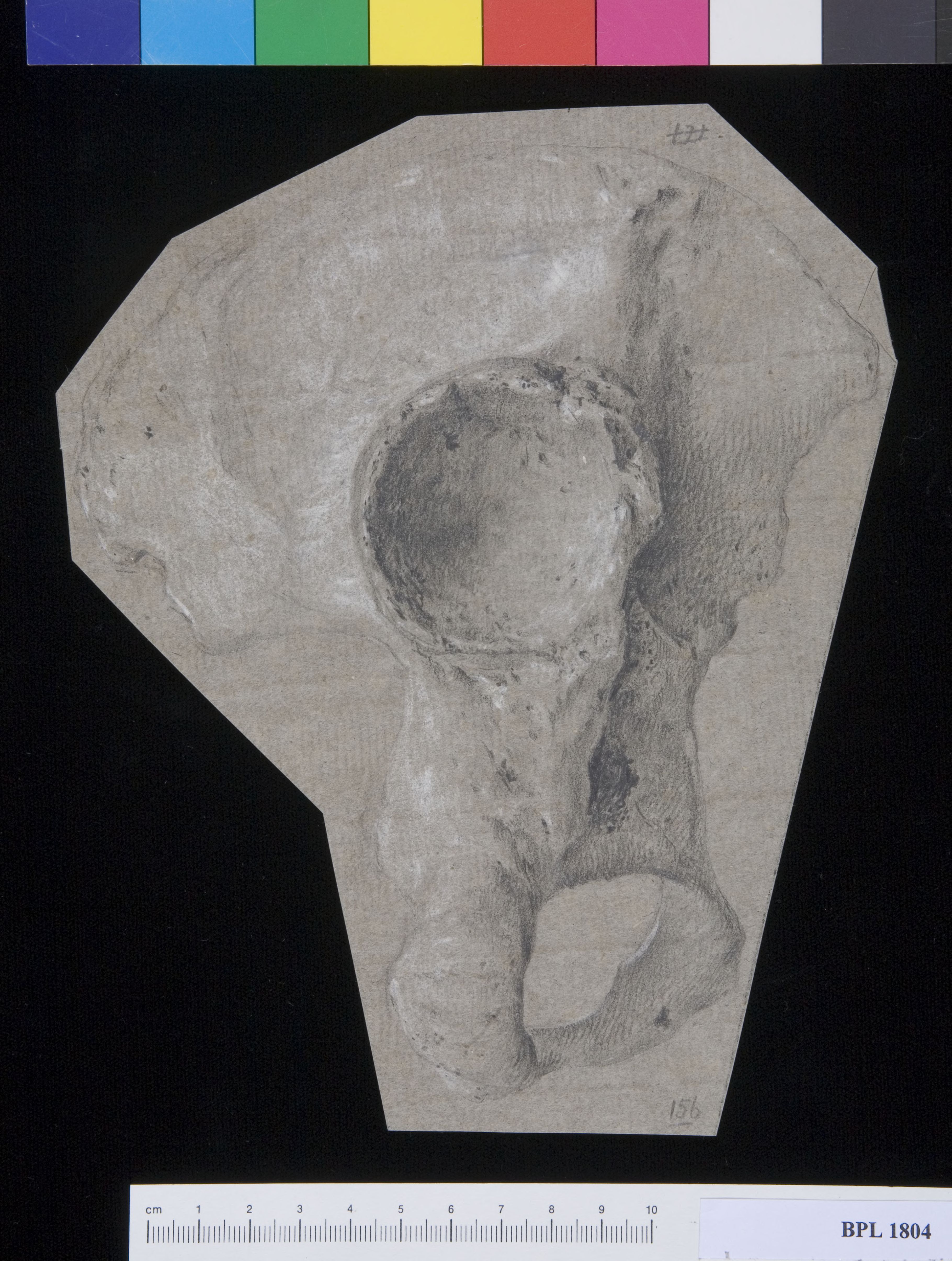 Pathology, fractures (Femur and hip)