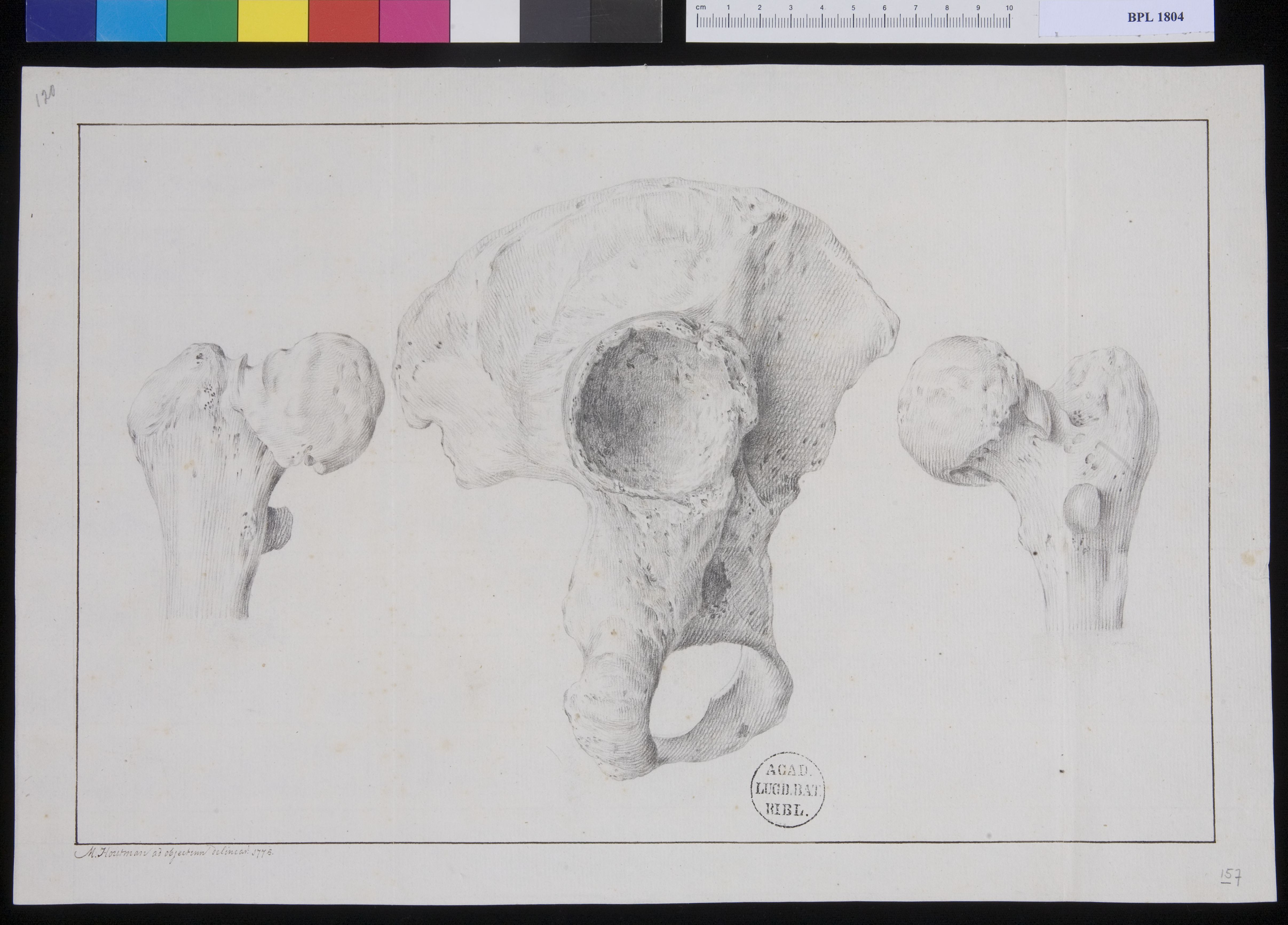 Pathology, fractures (Femur and hip)