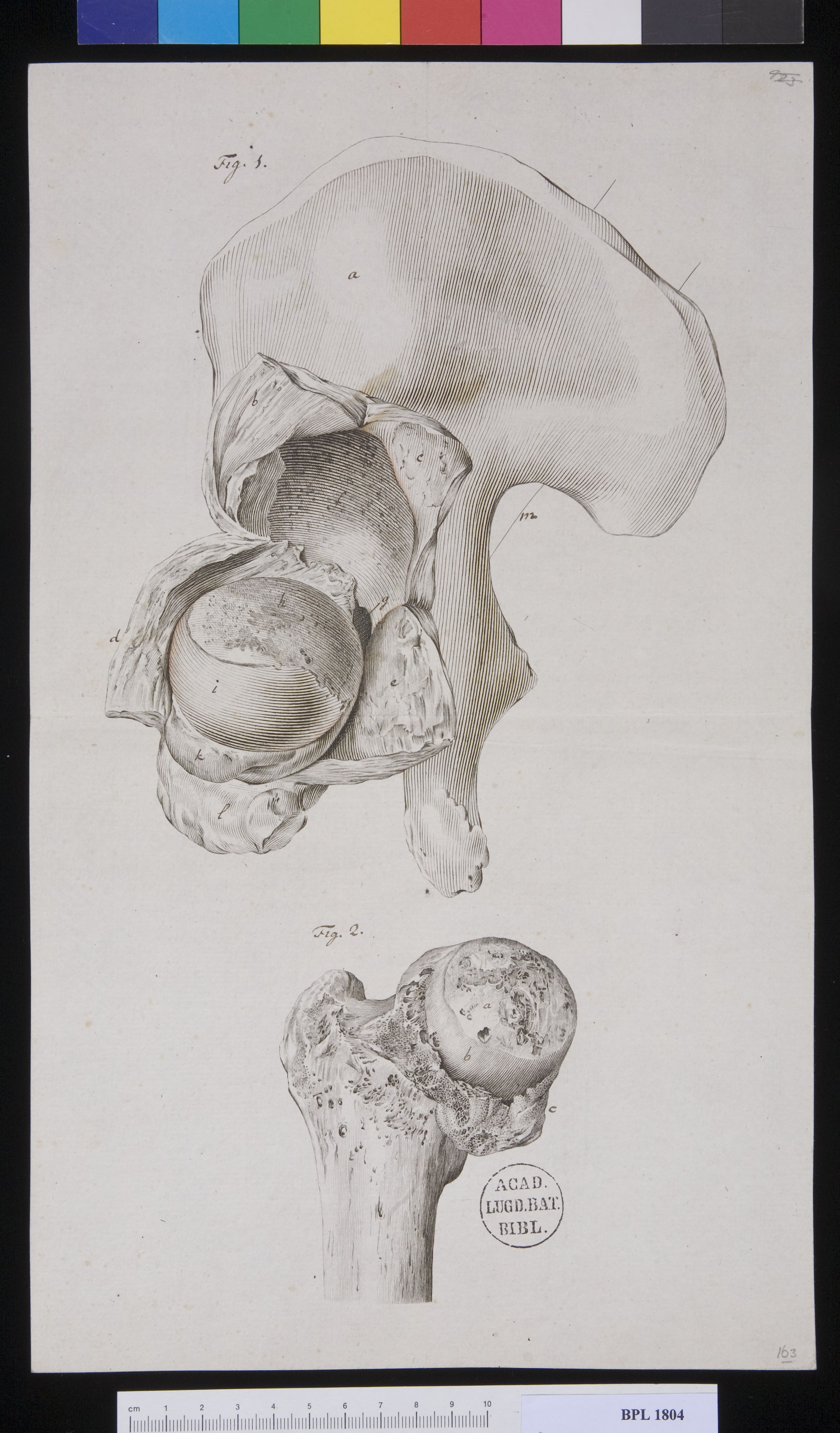 Pathology, fractures (Femur and hip)