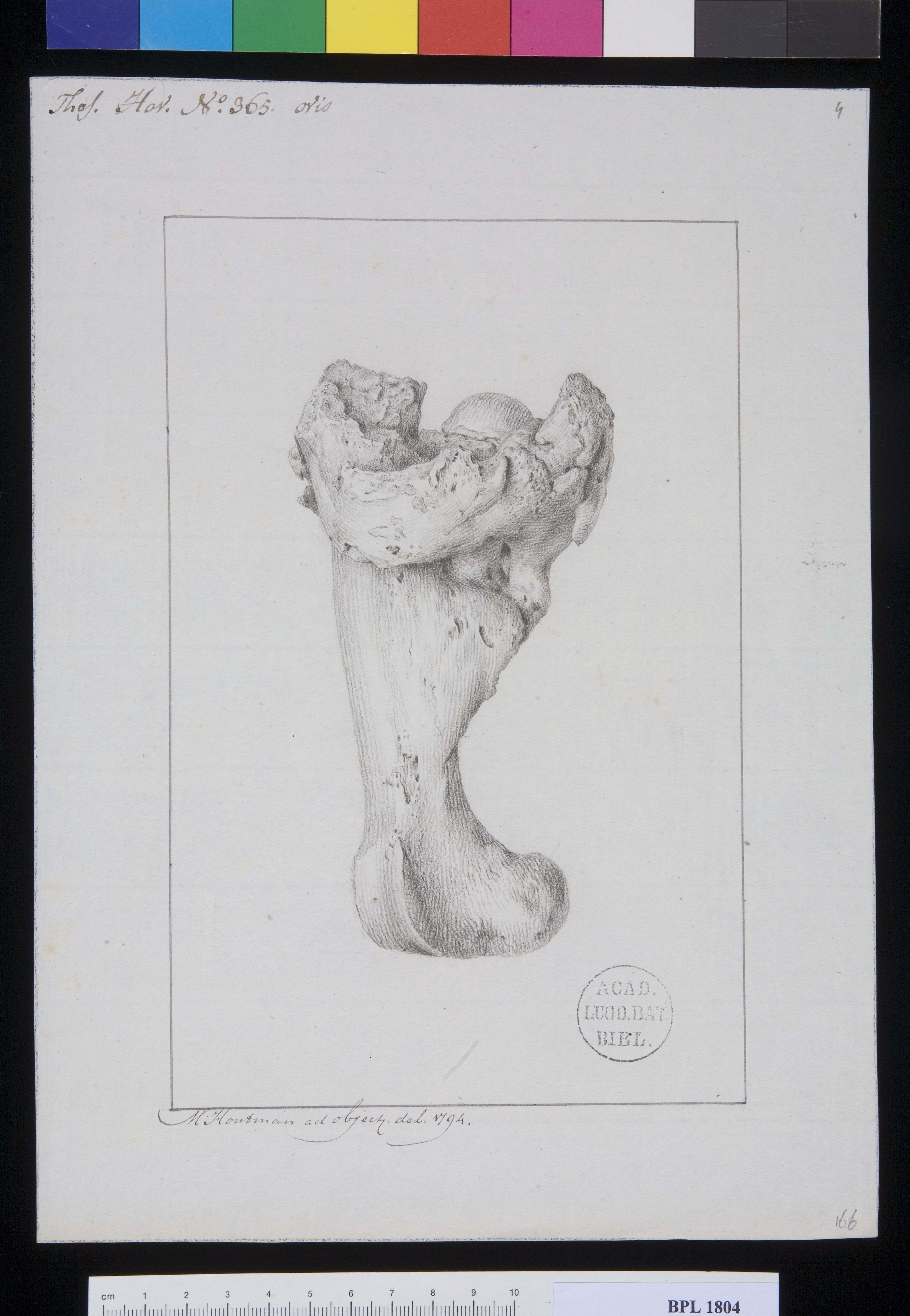 Pathology, fractures (Femur)