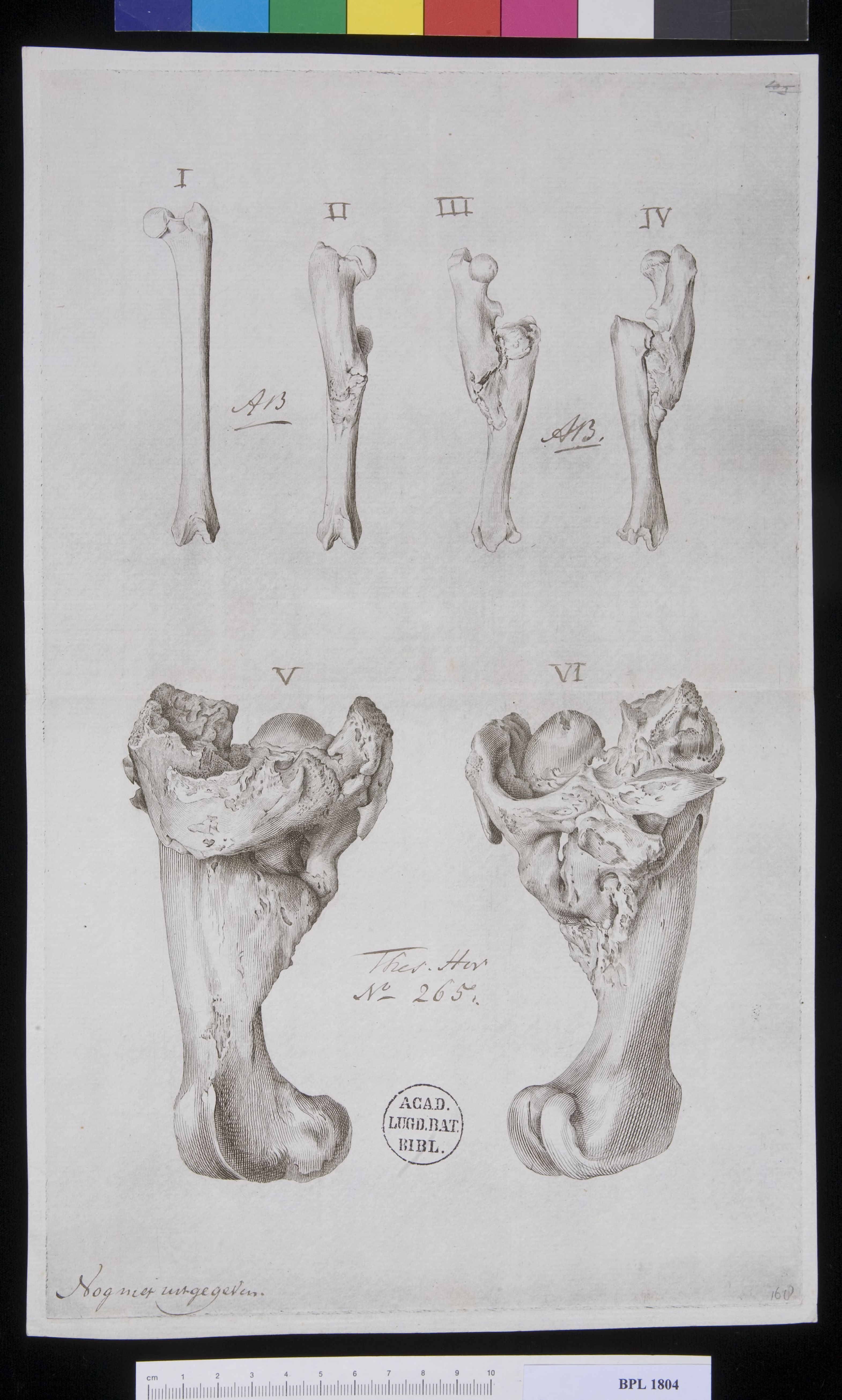 Pathology, fractures (Femur)