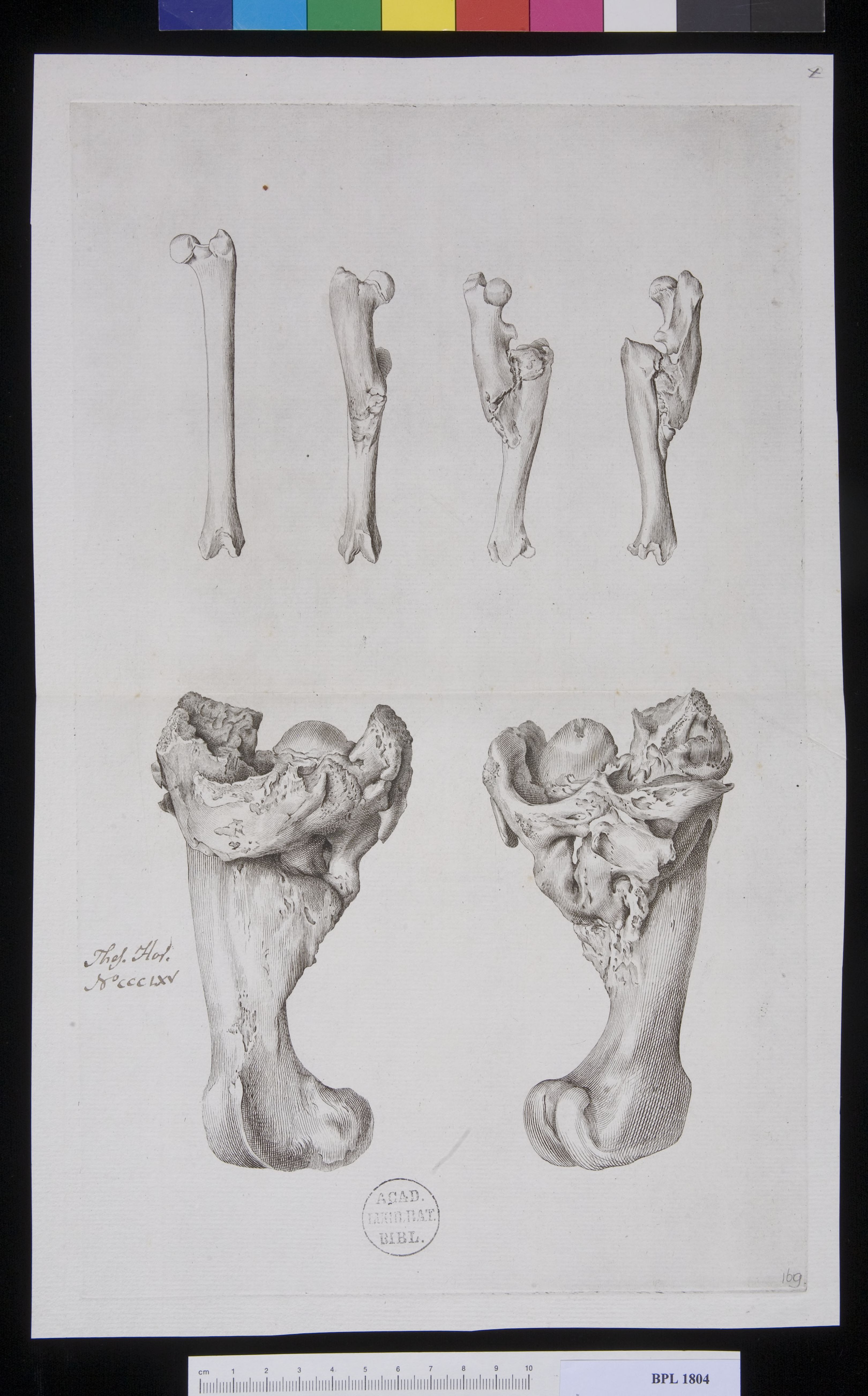 Pathology, fractures (Femur)
