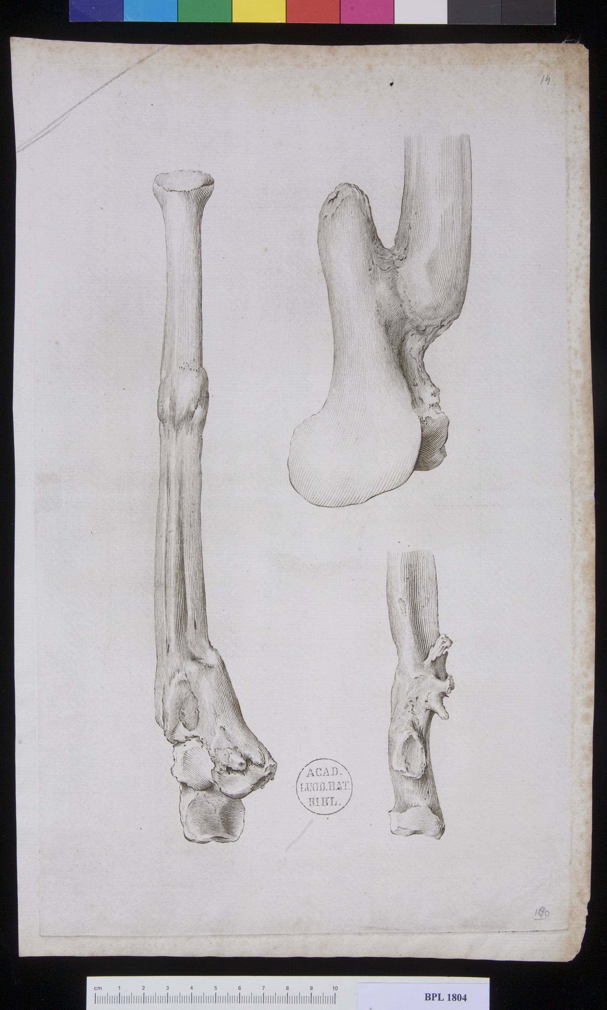 Pathology, fractures (Forearm)
