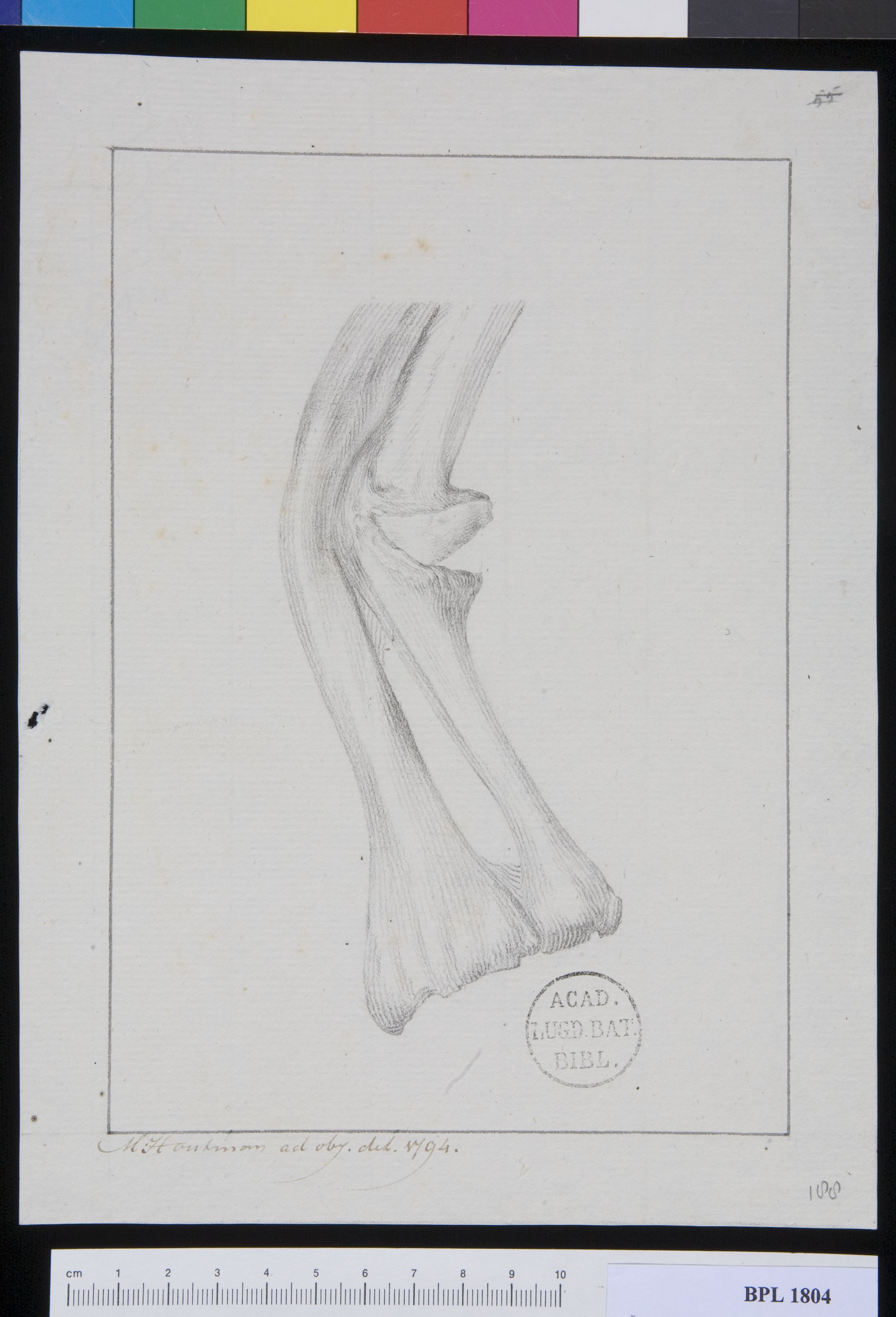 Pathology, fractures (Forearm)