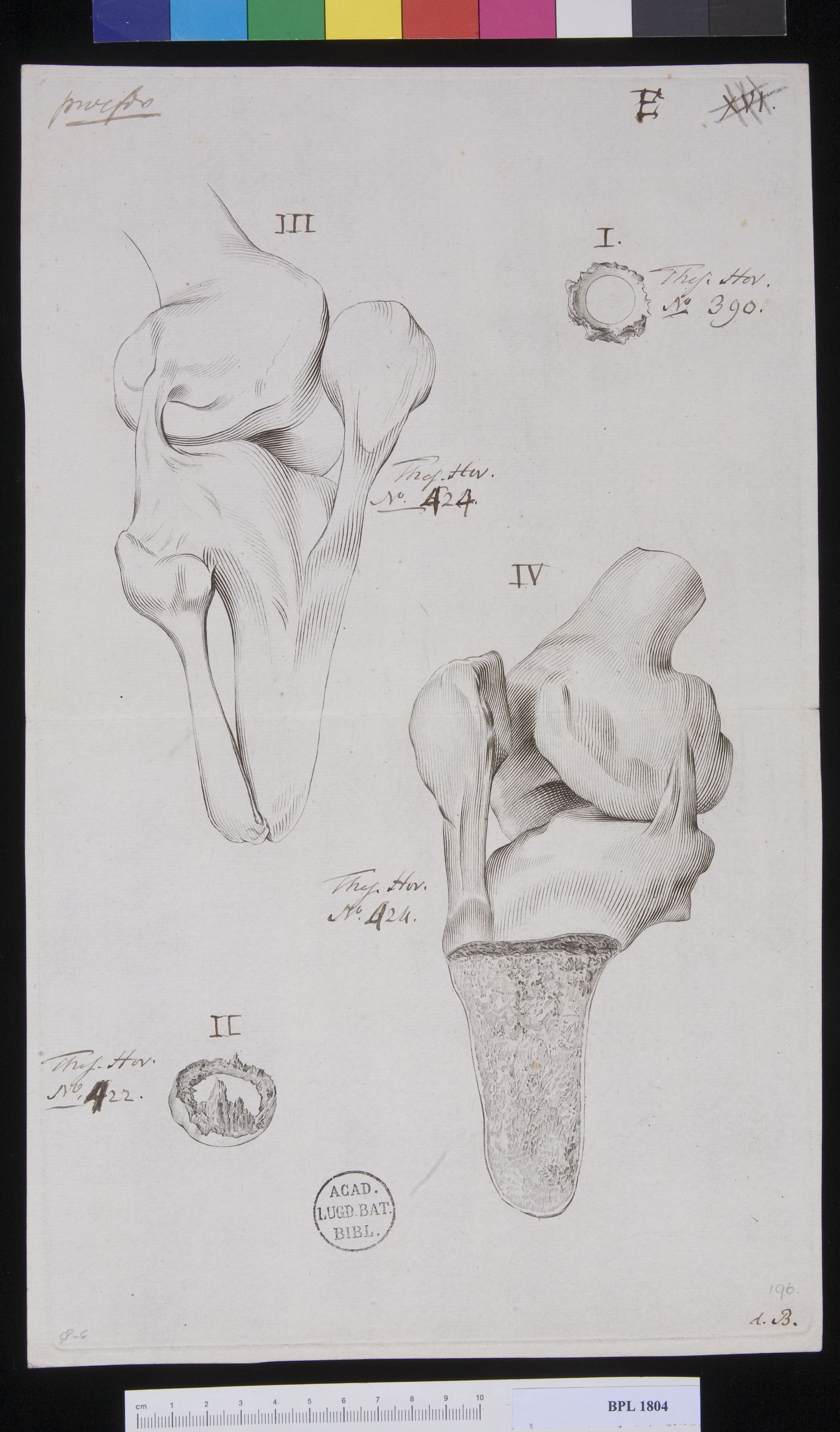 Pathology, fractures (Knee)
