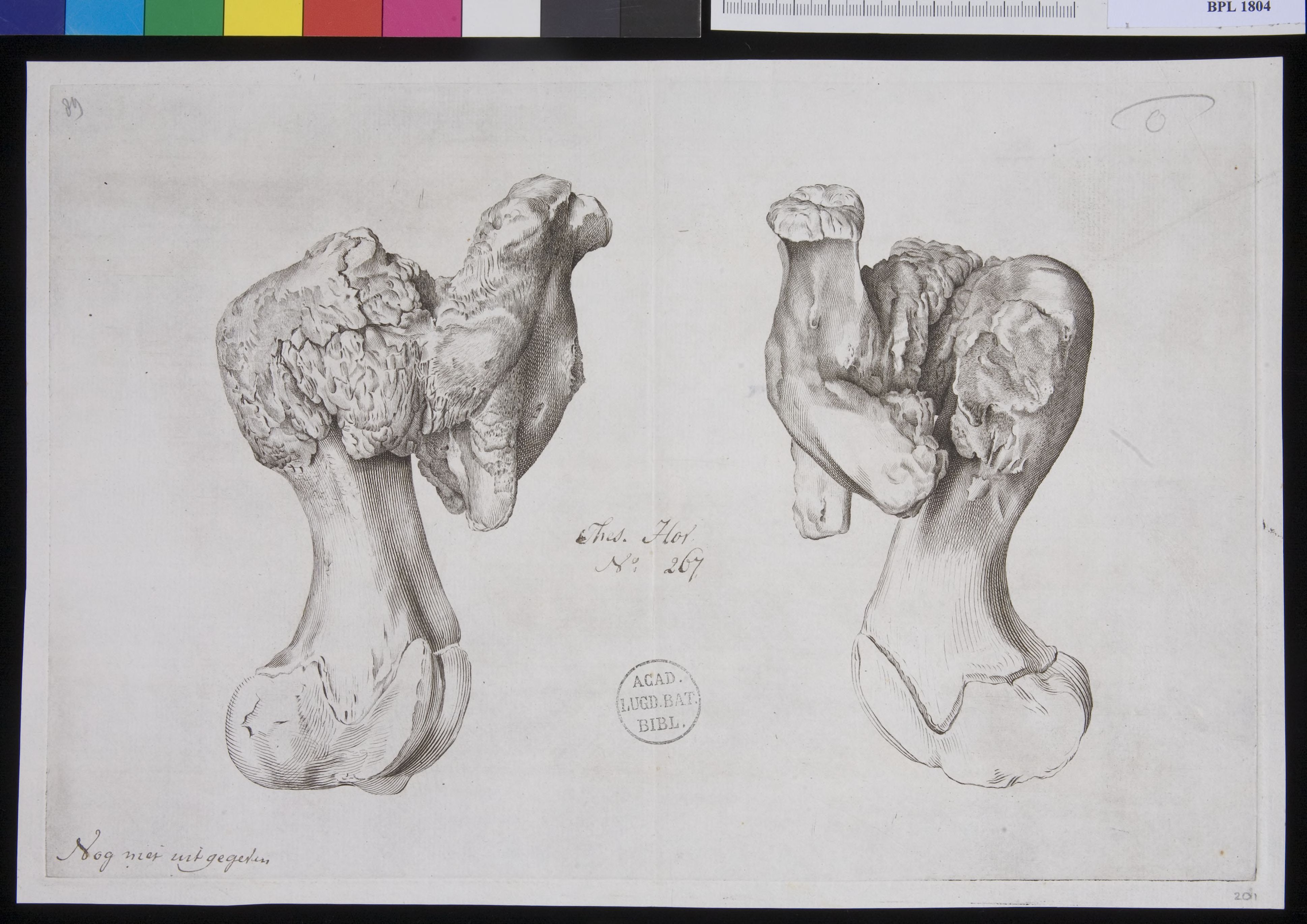 Pathology, fractures (Femur)