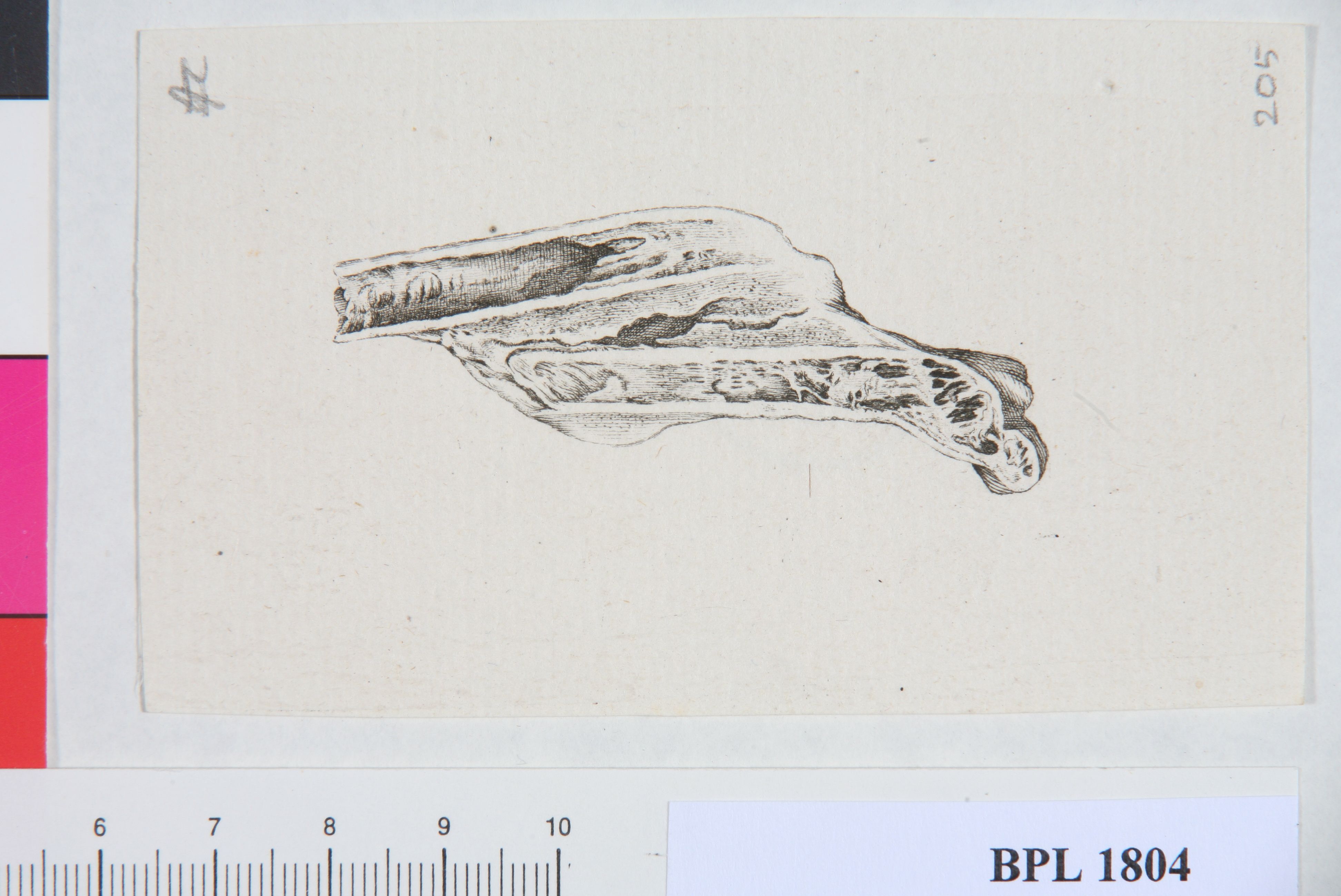 Pathology, fractures (Femur)
