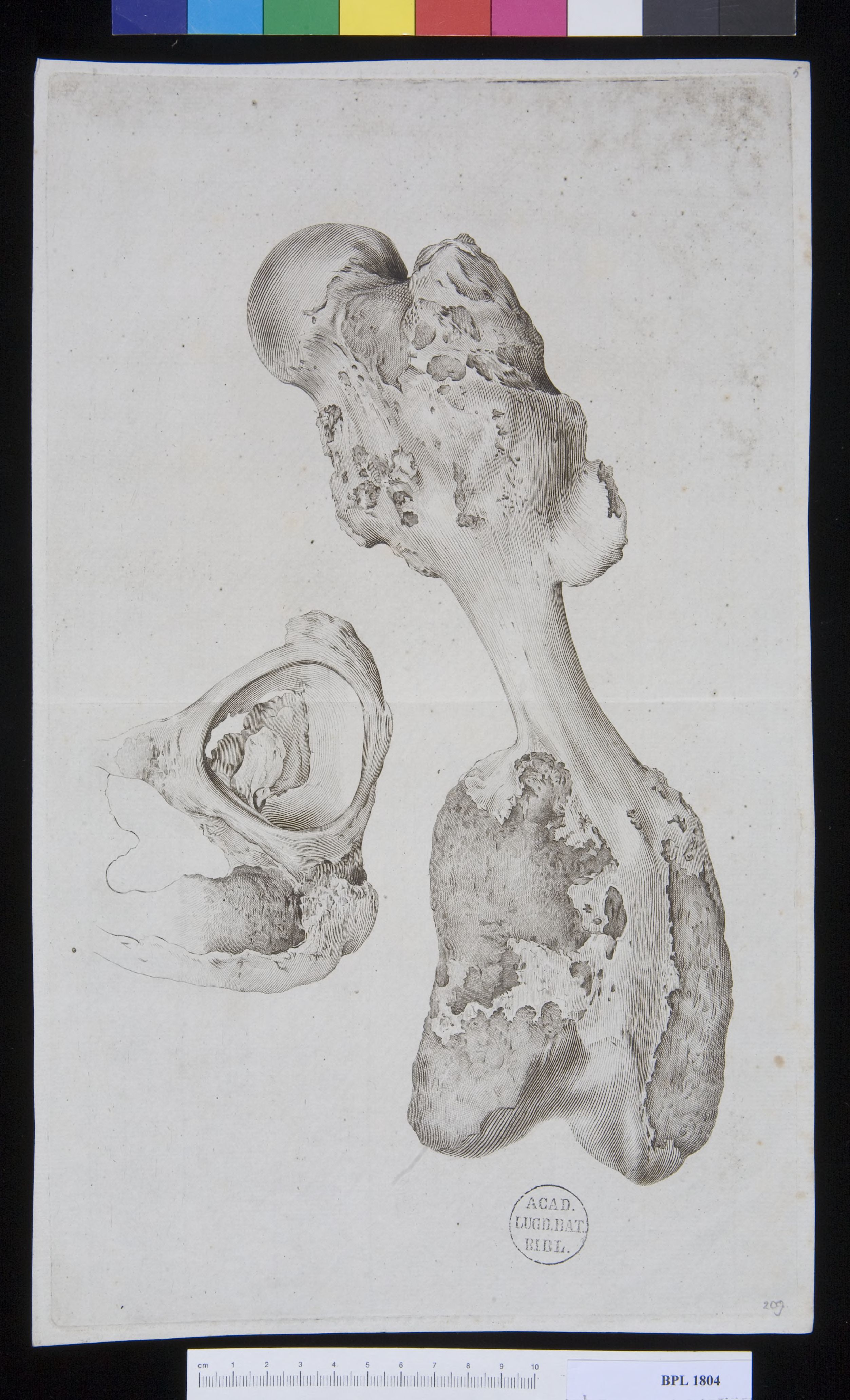 Pathology, fractures (vertebrae lumborum)