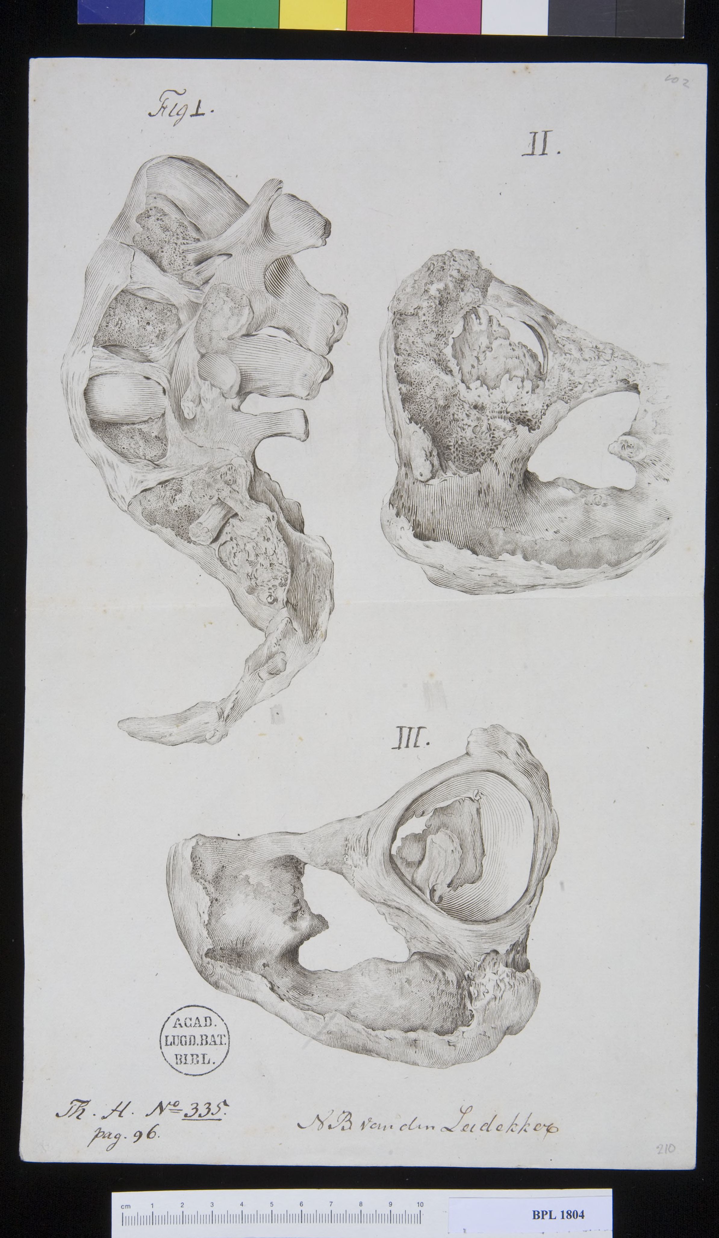 Pathology, fractures (vertebrae lumborum)