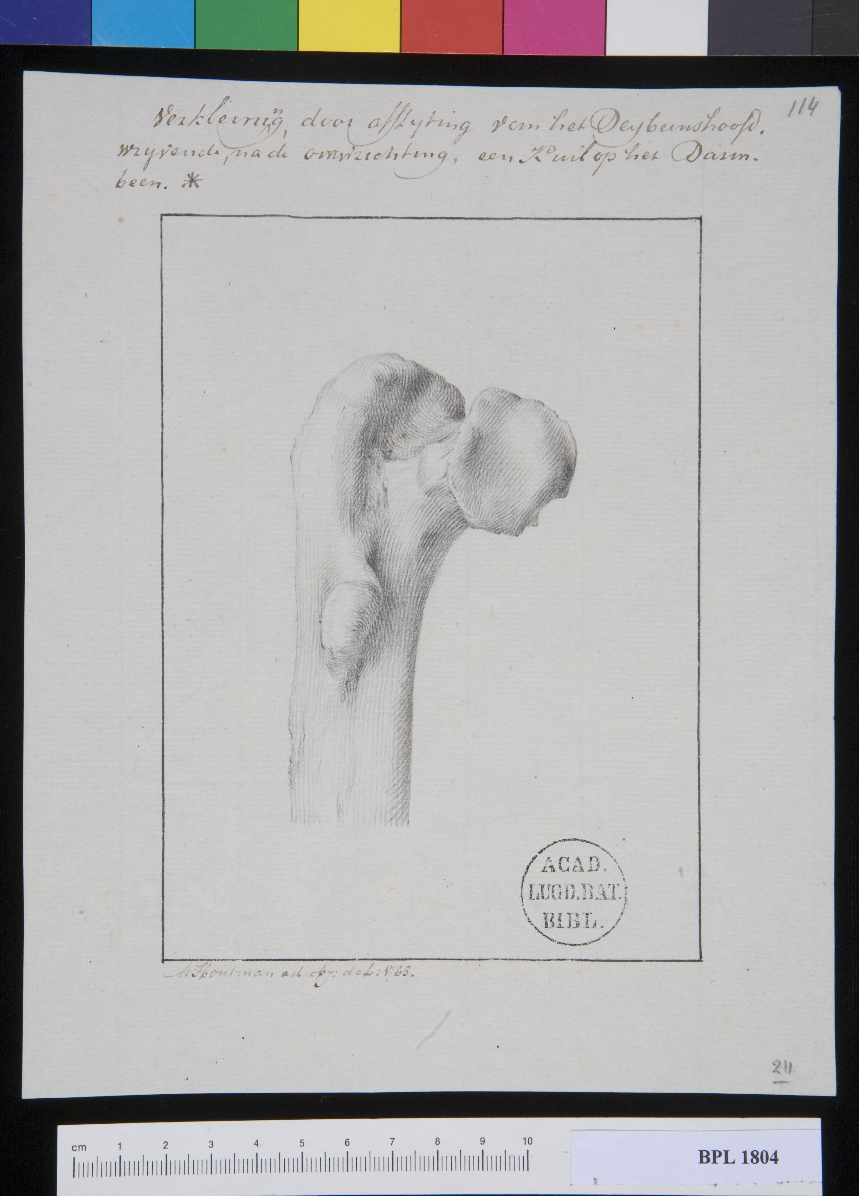 Pathology, fractures (Femur)