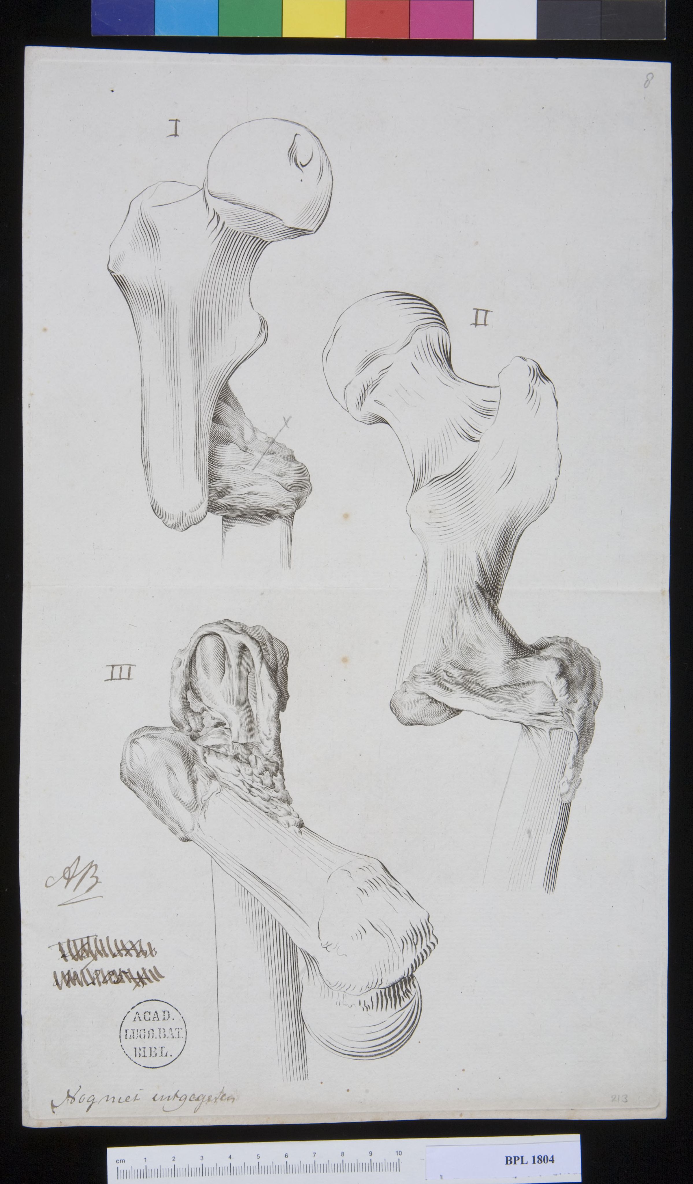 Pathology, fractures (Femur)