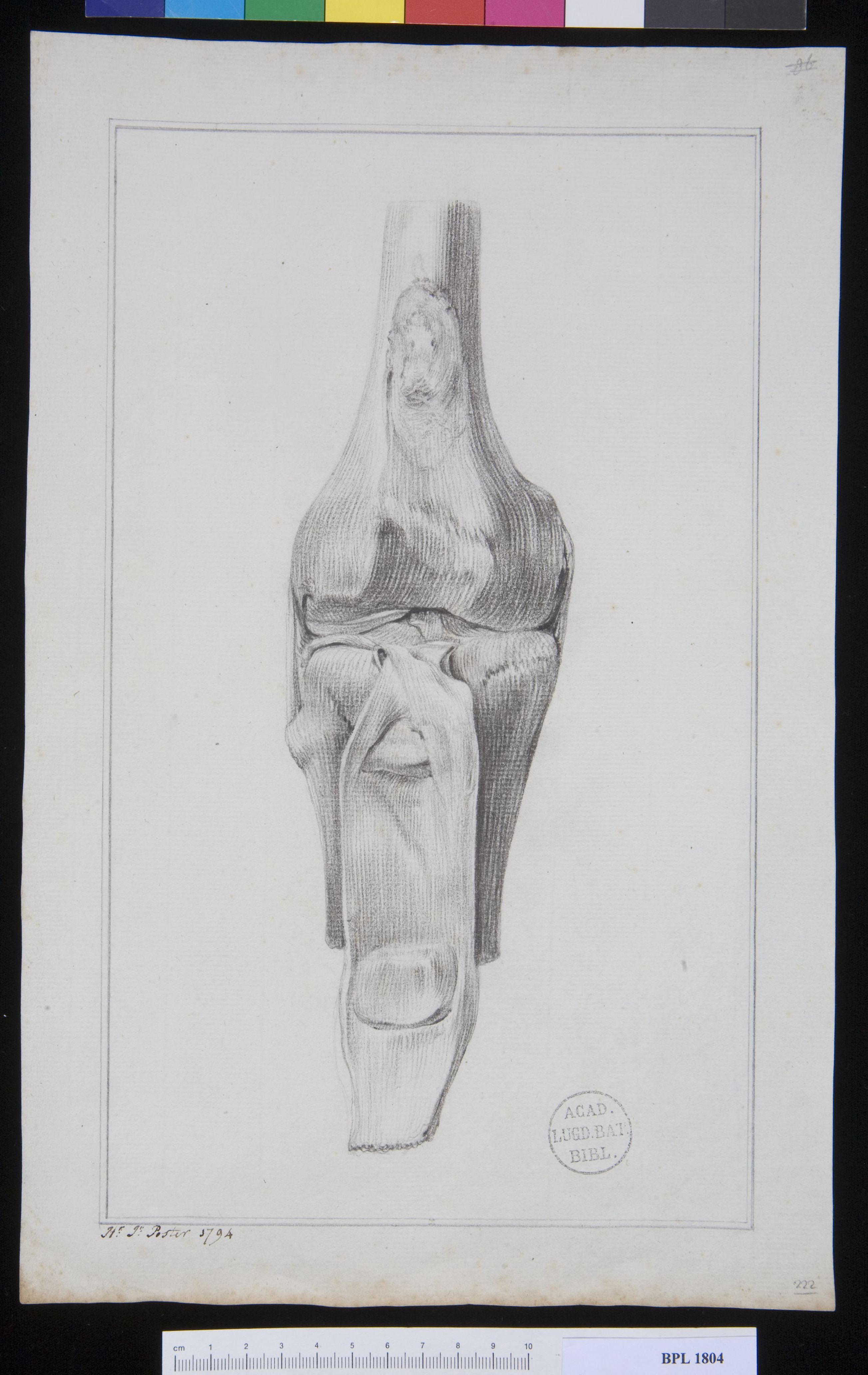 Pathology, fractures (Patella)