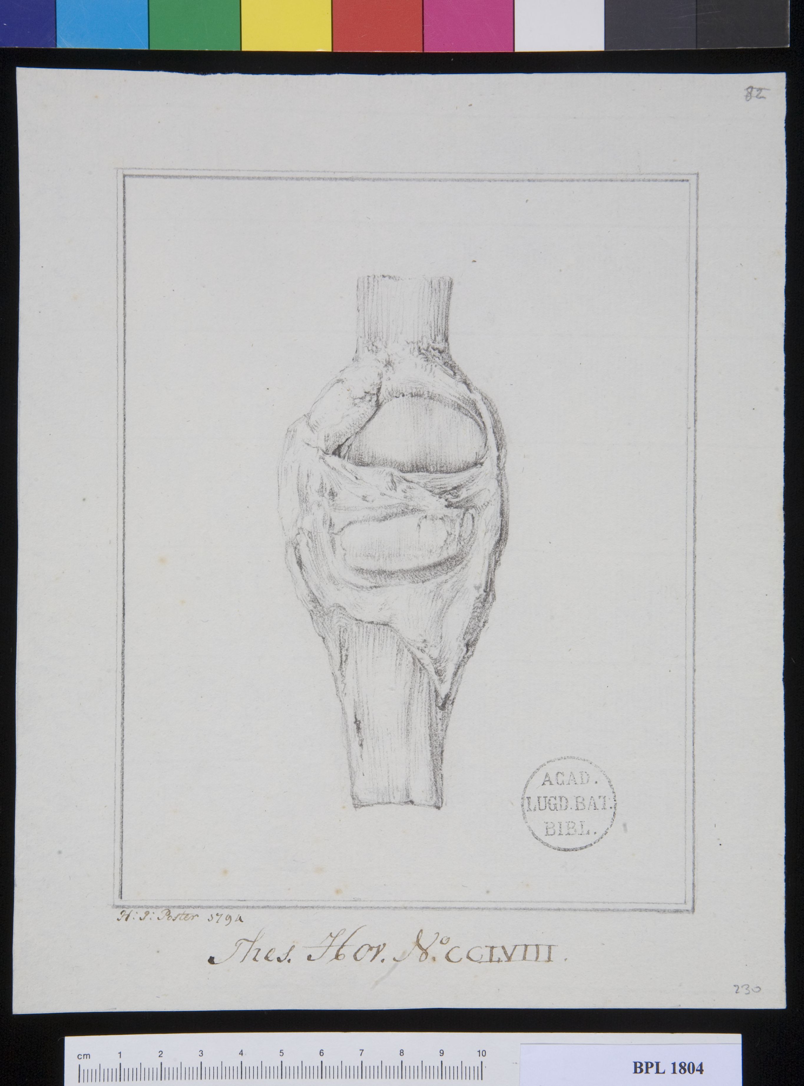 Pathology, fractures (Patella)