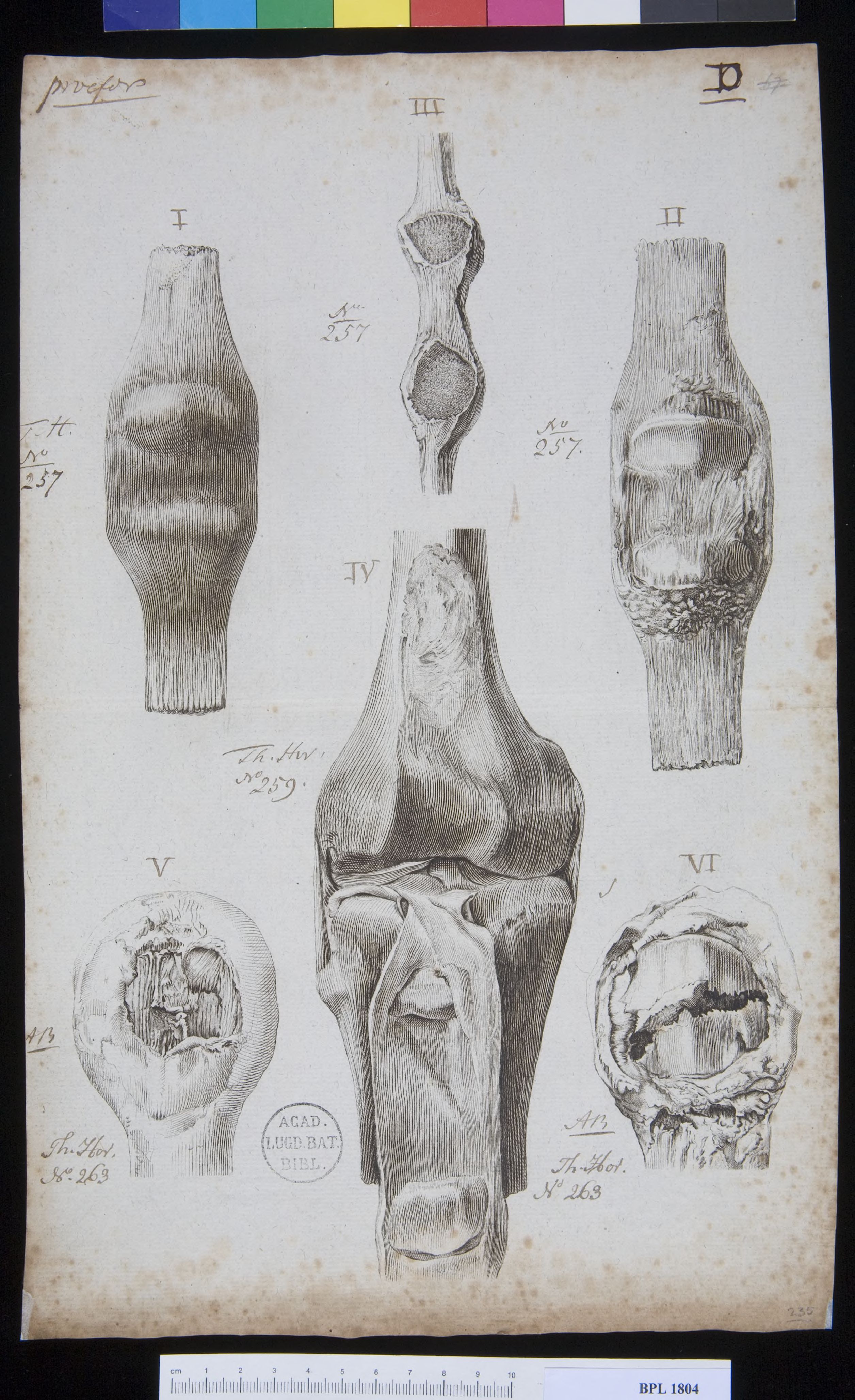 Pathology, fractures (Patella)