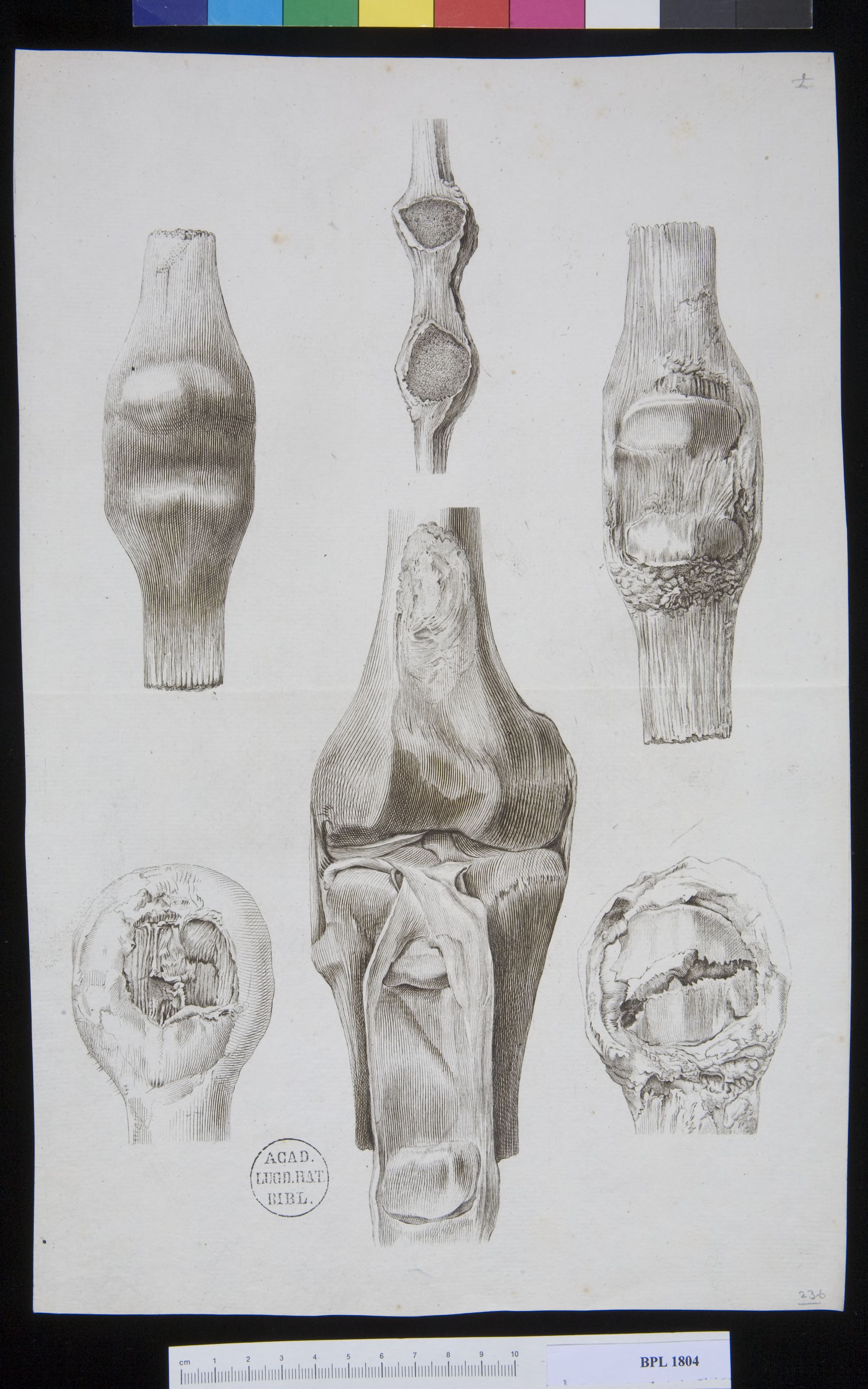 Pathology, fractures (Patella)