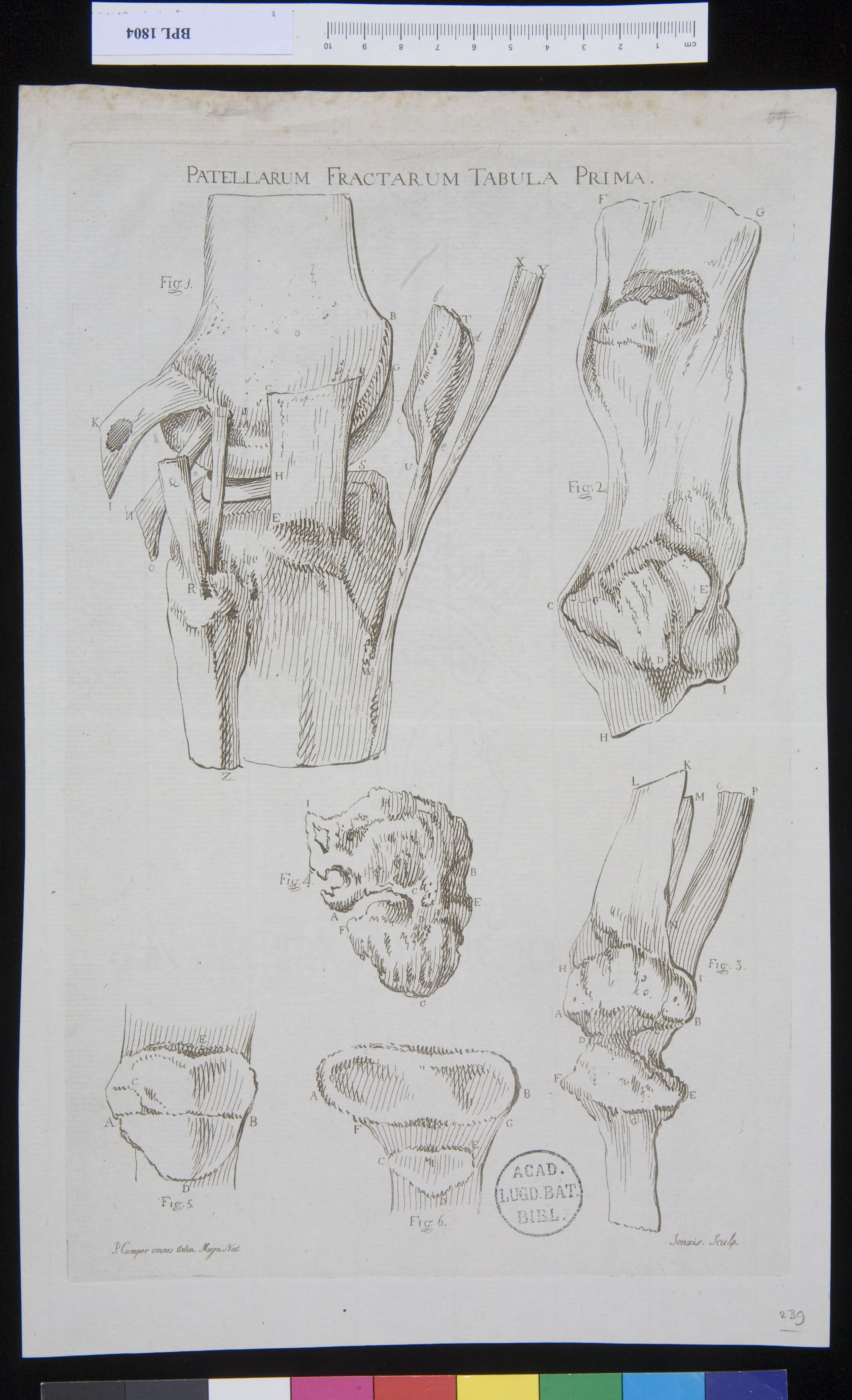 Pathology, fractures (Patella)