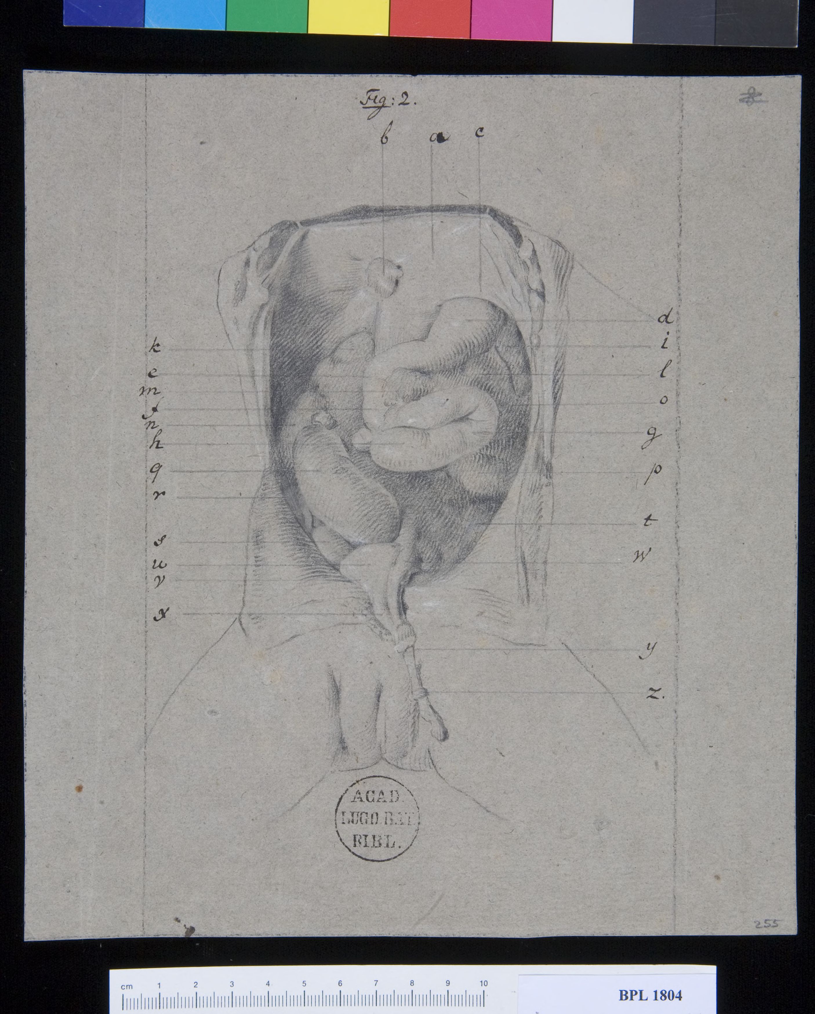 Pathology, fractures (Torso, organs)