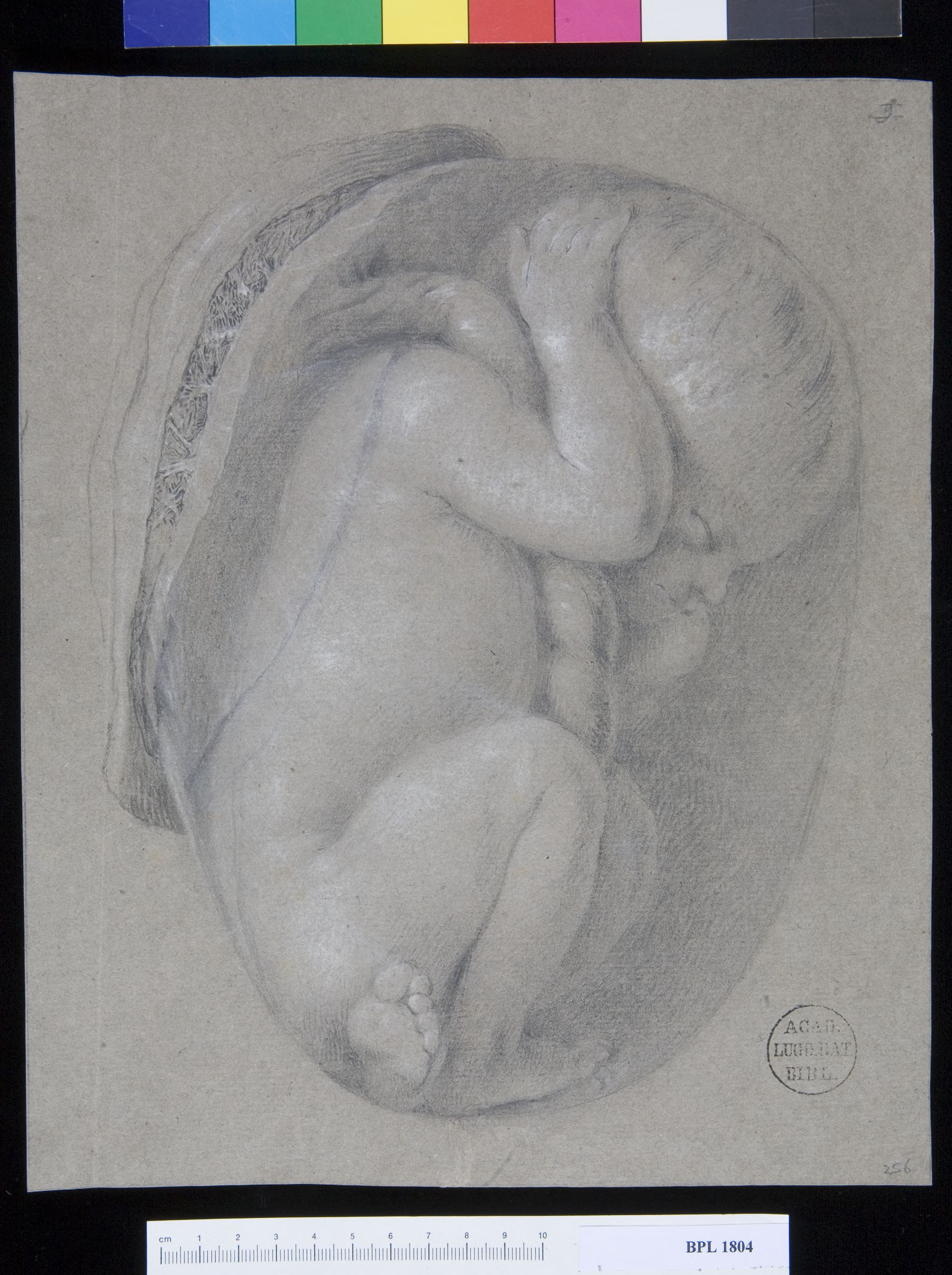 Pathology, fractures (Foetus)