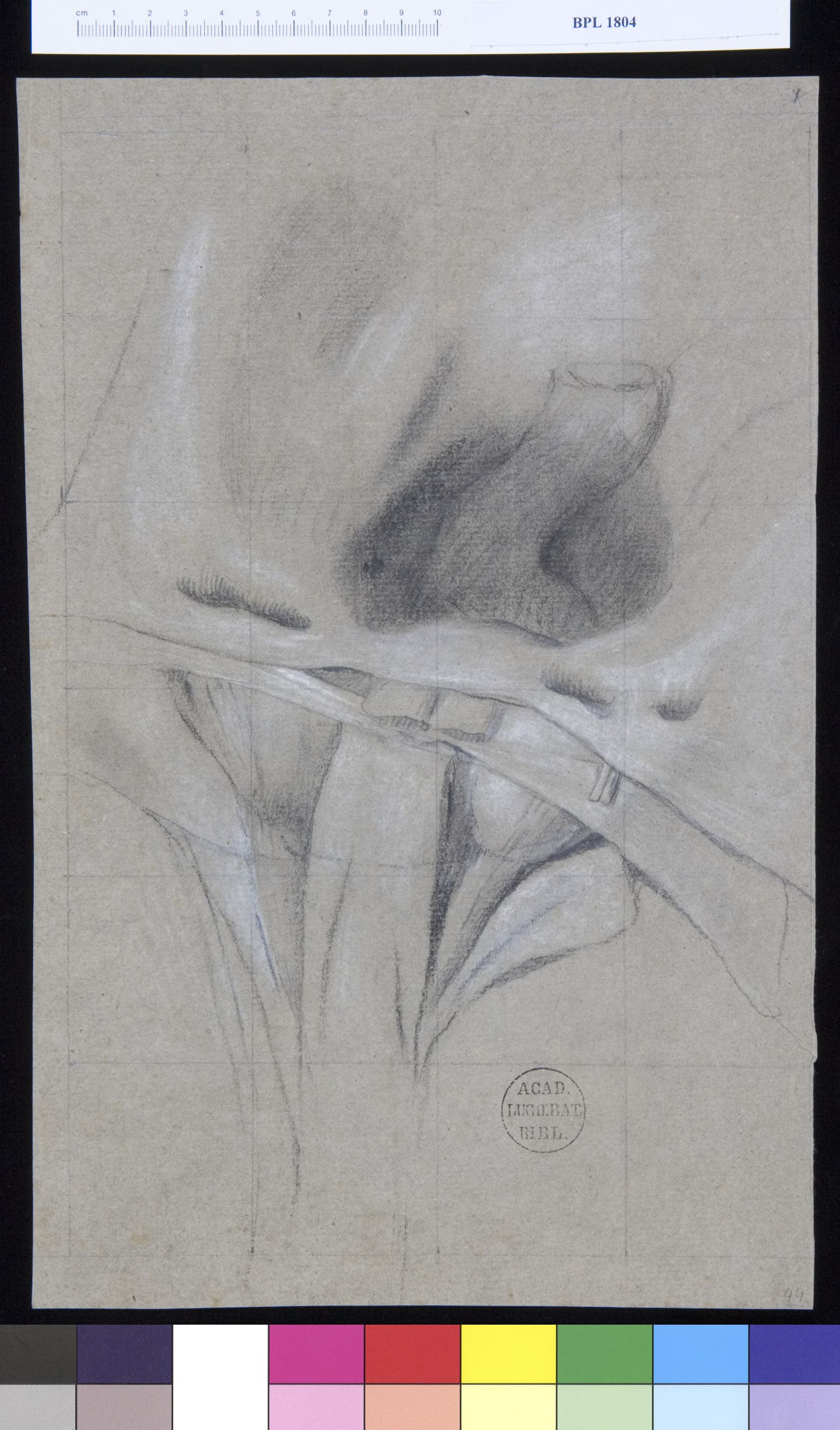 Pathology, fractures