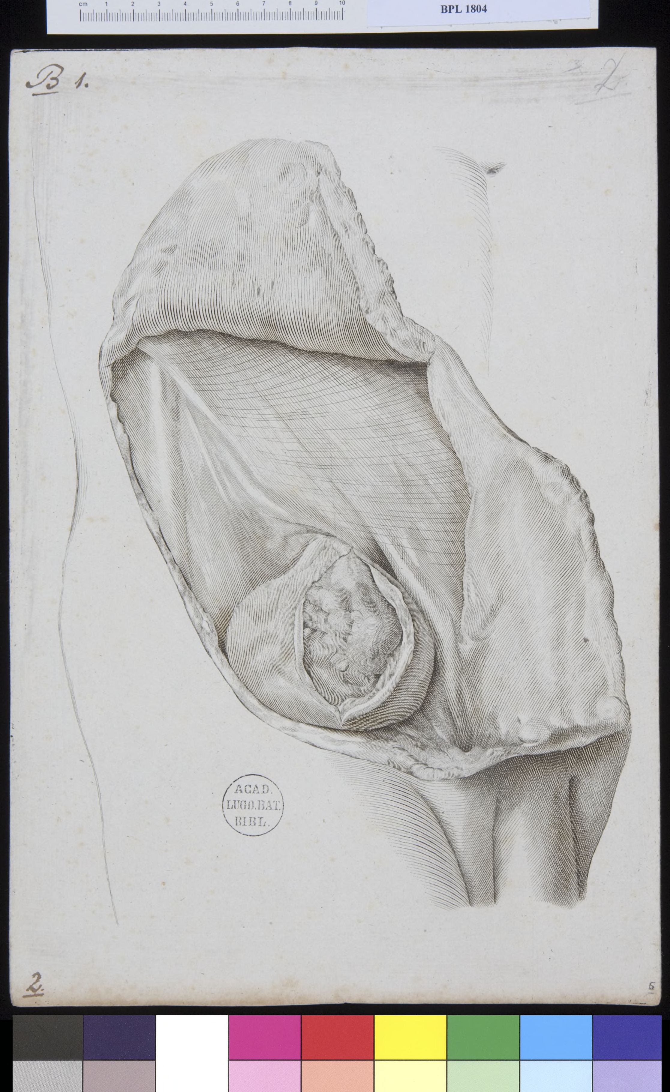Pathology, fractures