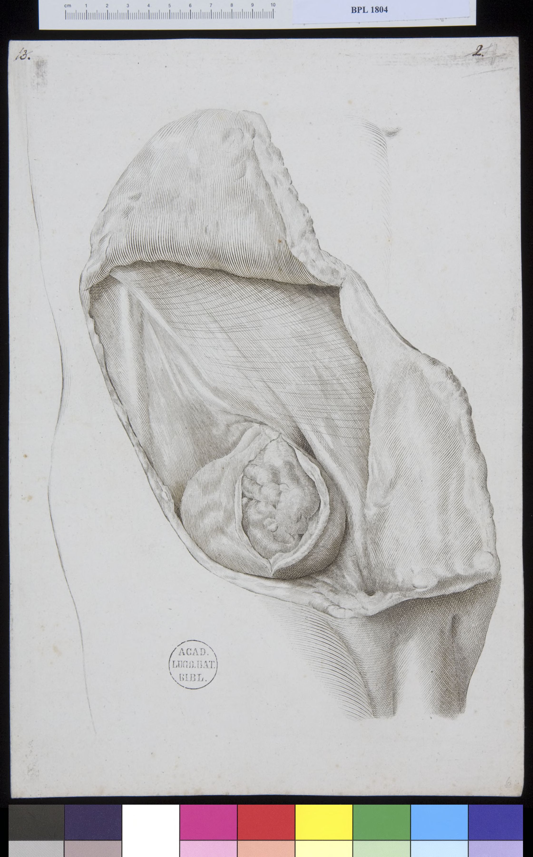 Pathology, fractures