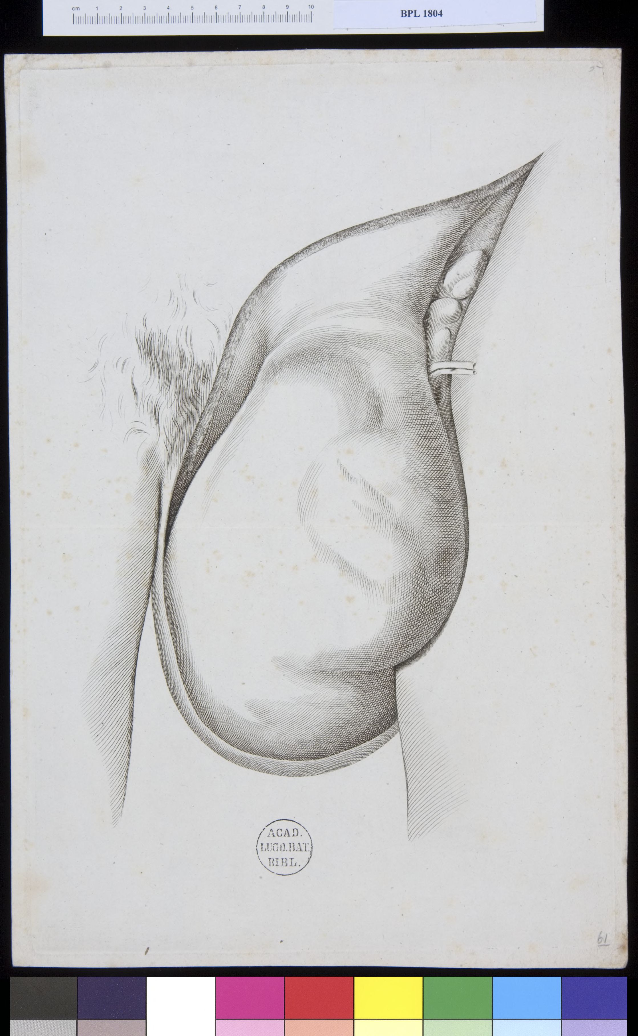 Pathology, fractures