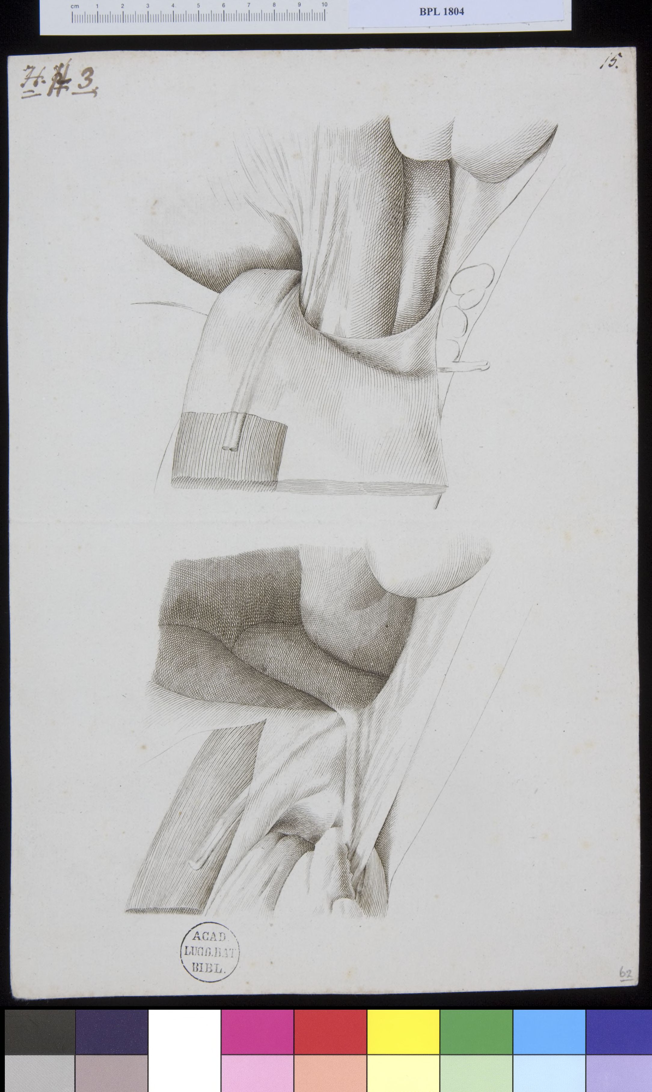 Pathology, fractures