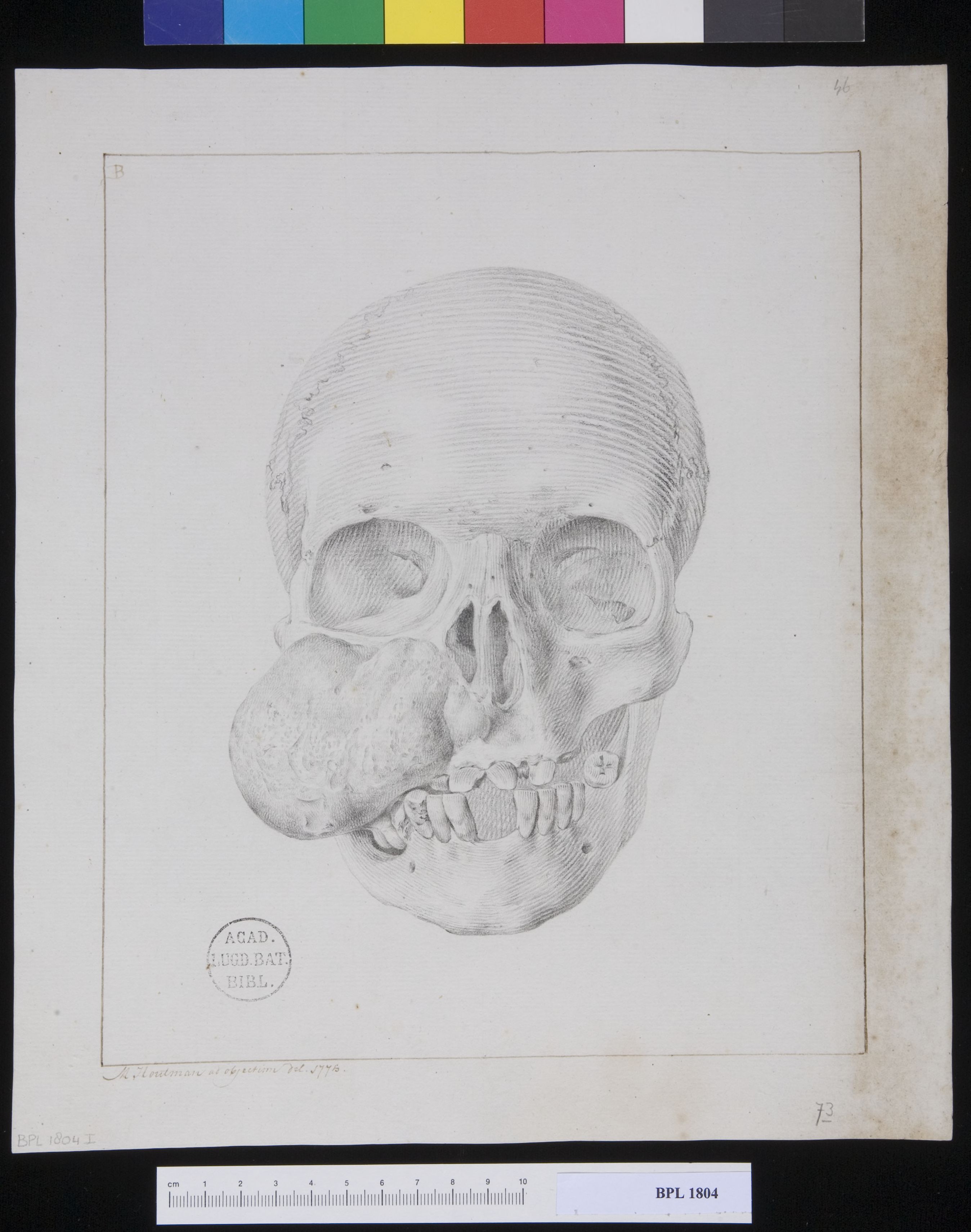 Pathology, fractures (Skull of the woman with a tumor in her cheek)