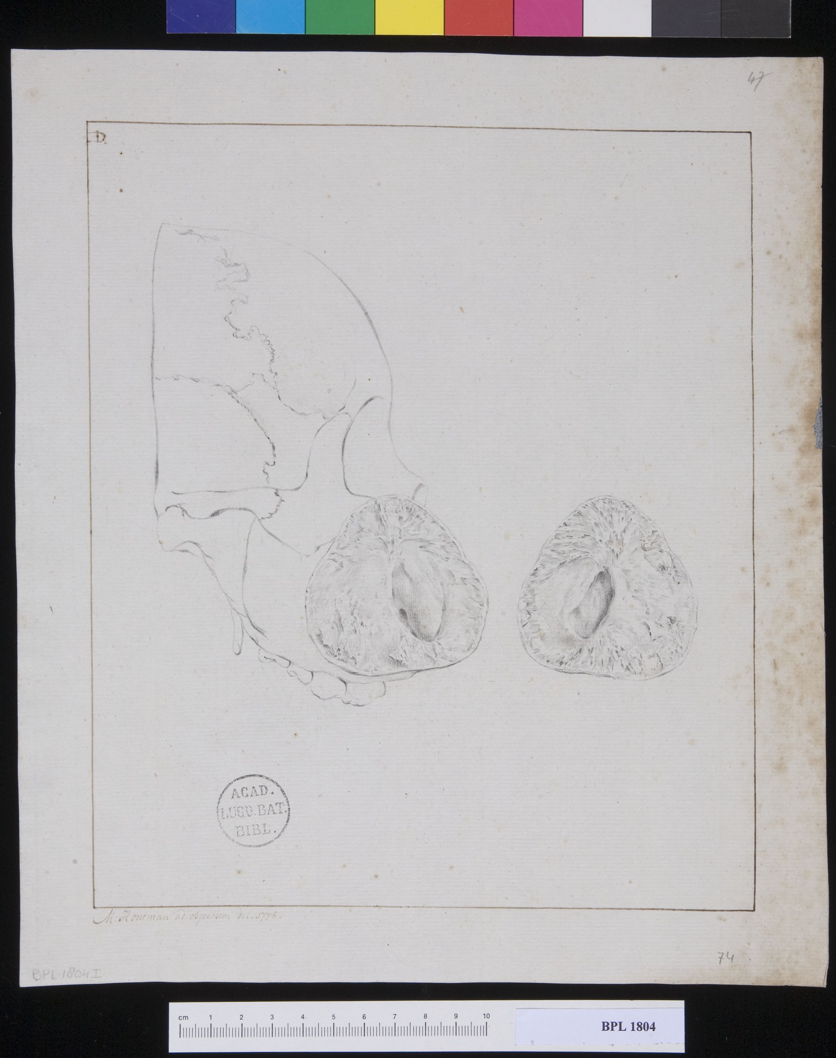 Pathology, fractures (Tumor from a woman's cheek)