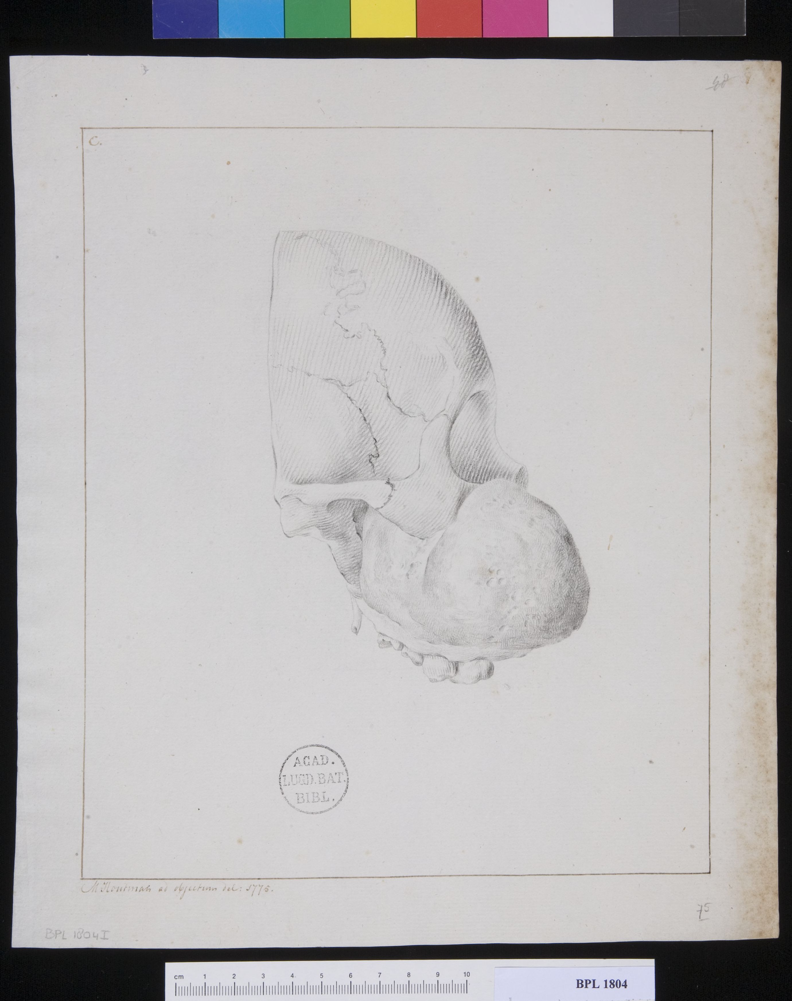 Pathology, fractures (Tumor from a woman's cheek)