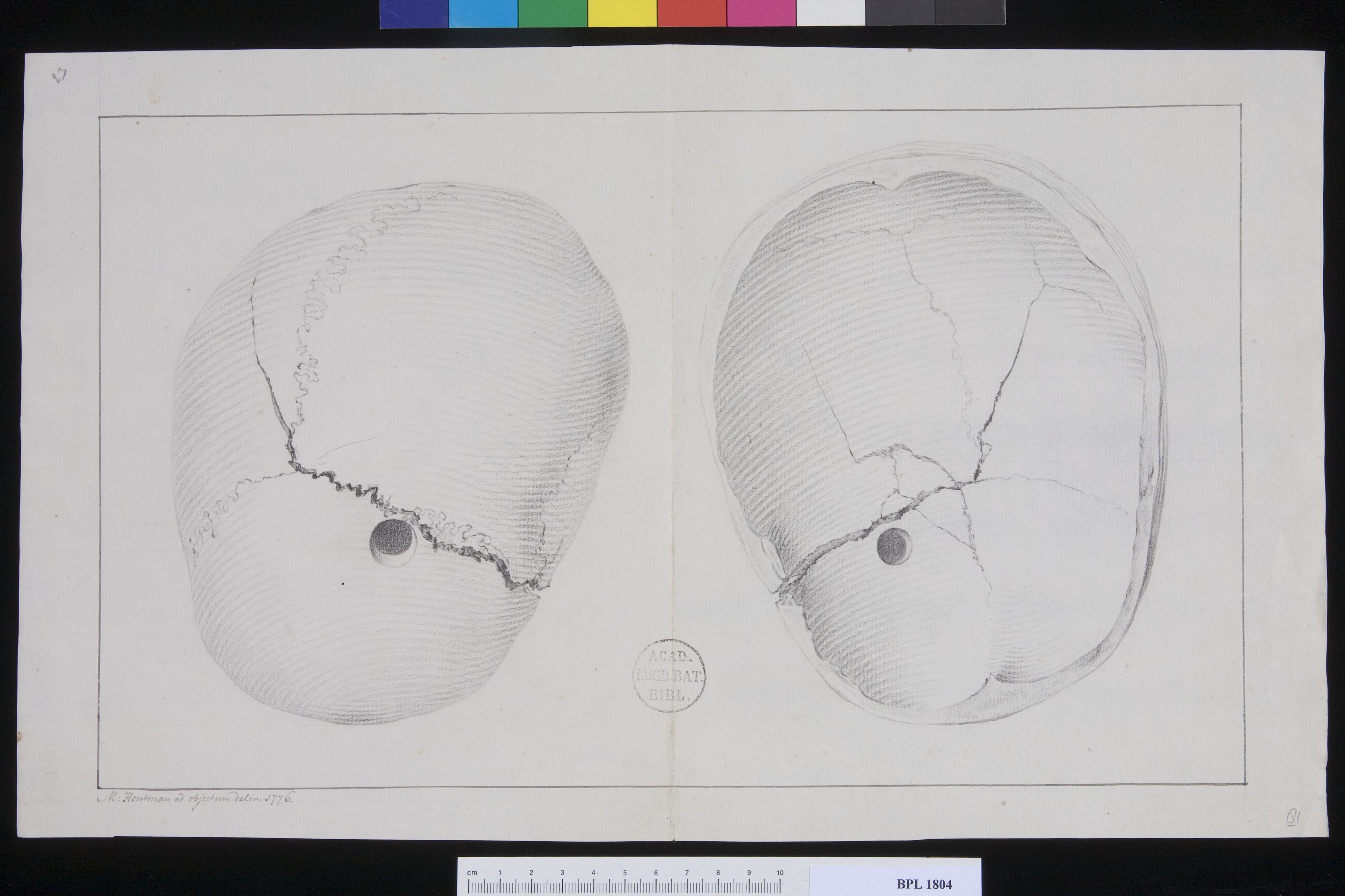 Pathology, fractures (Fractured skull)