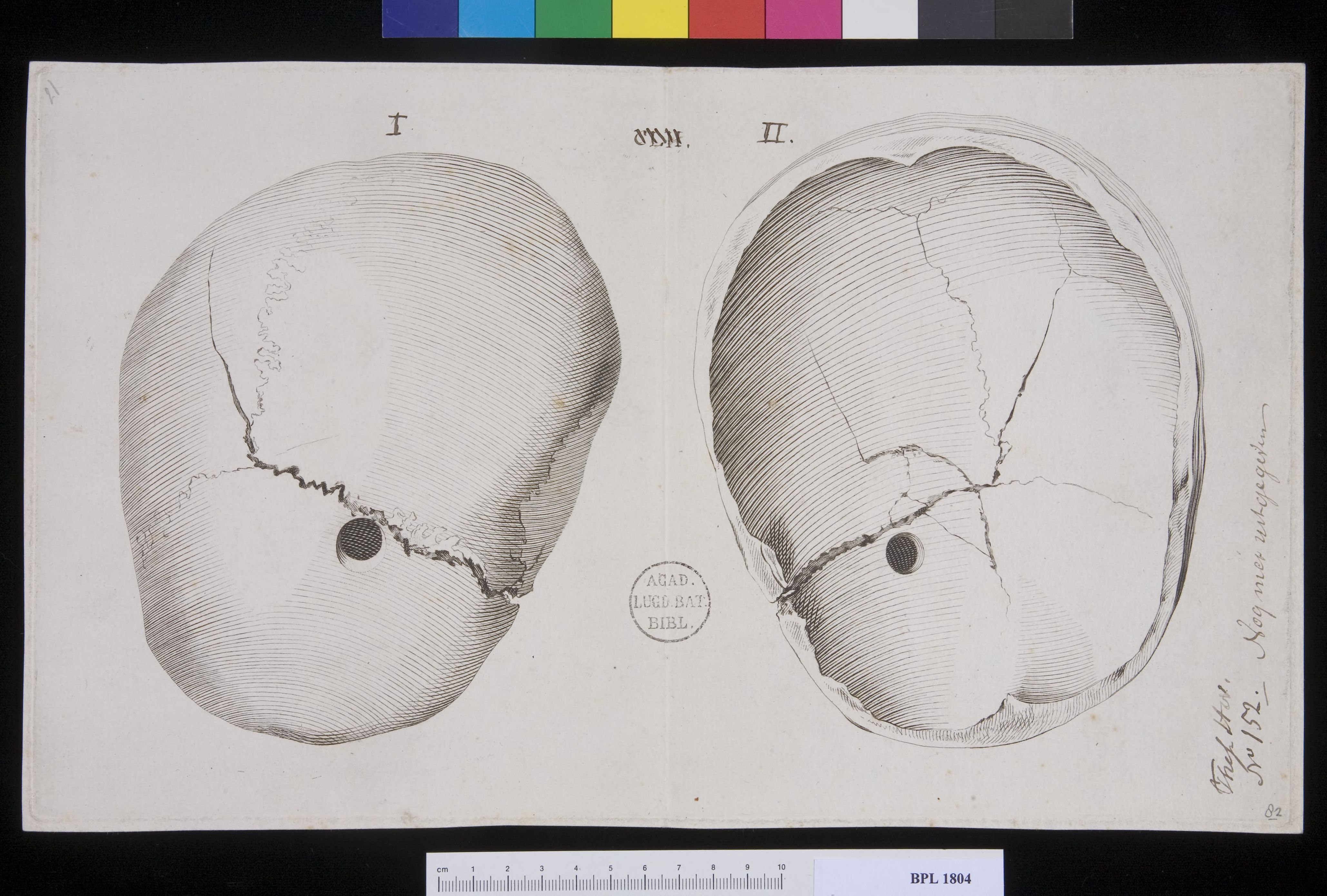 Pathology, fractures (Fractured skull)