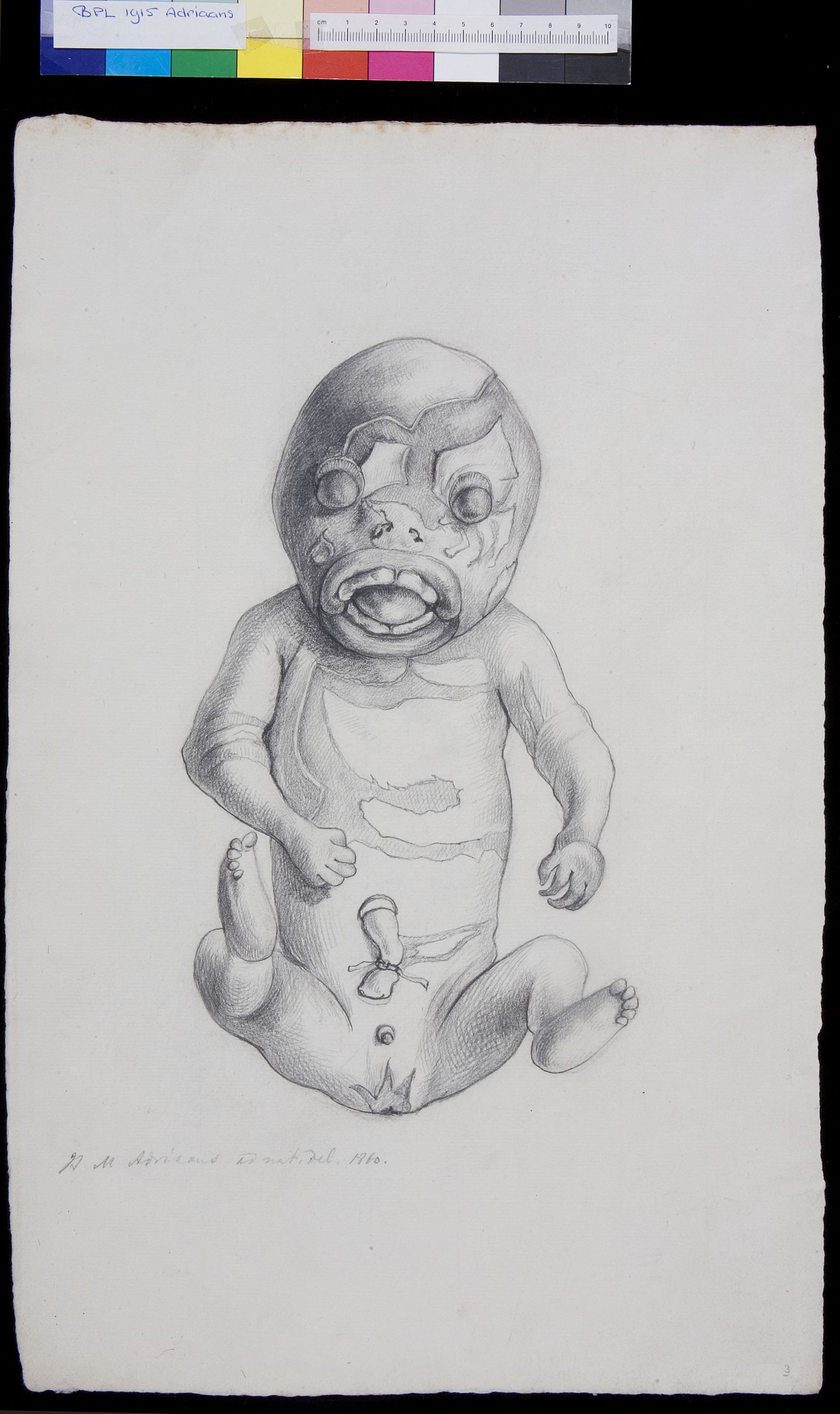 Foetus