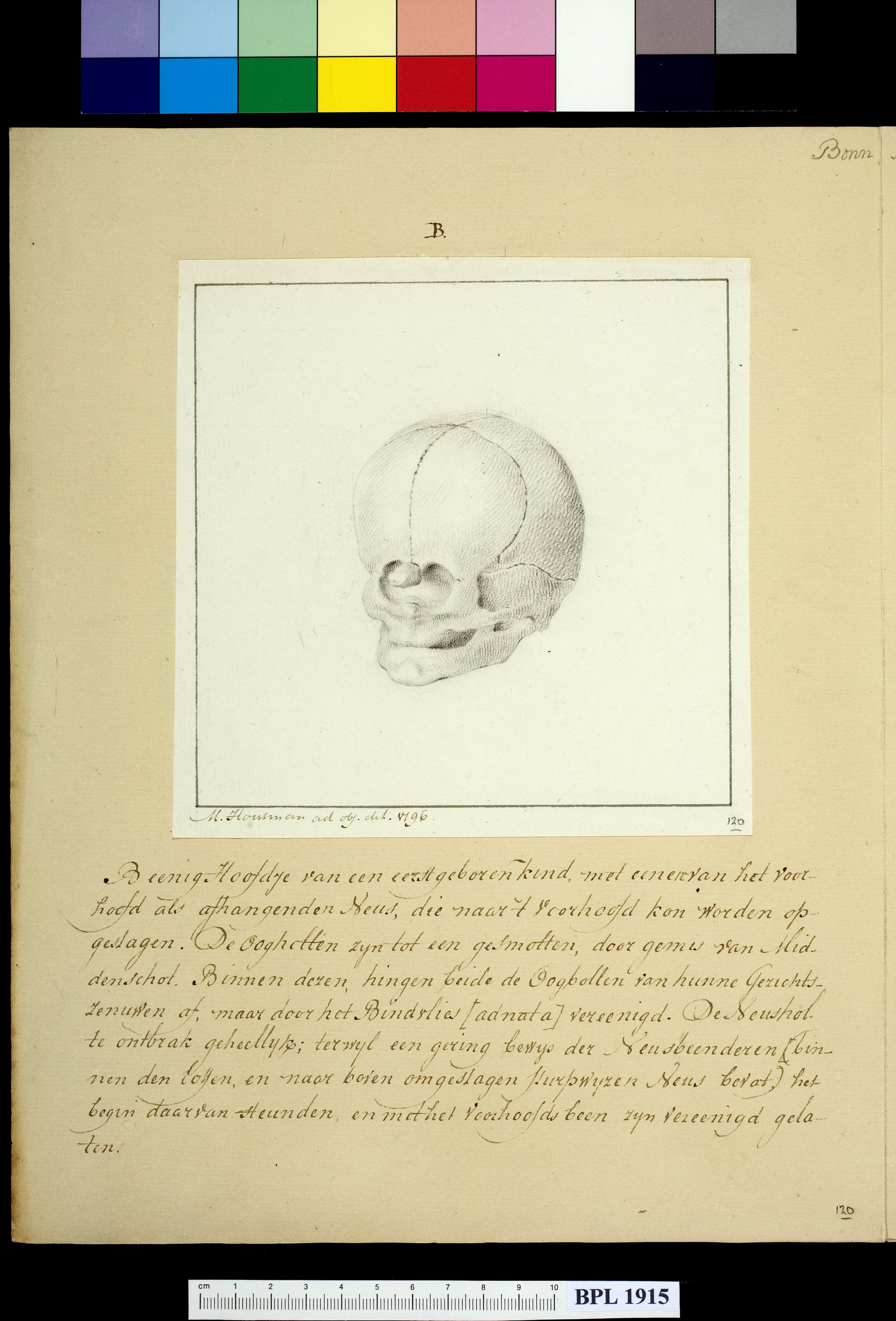 Skull of child with deformed head