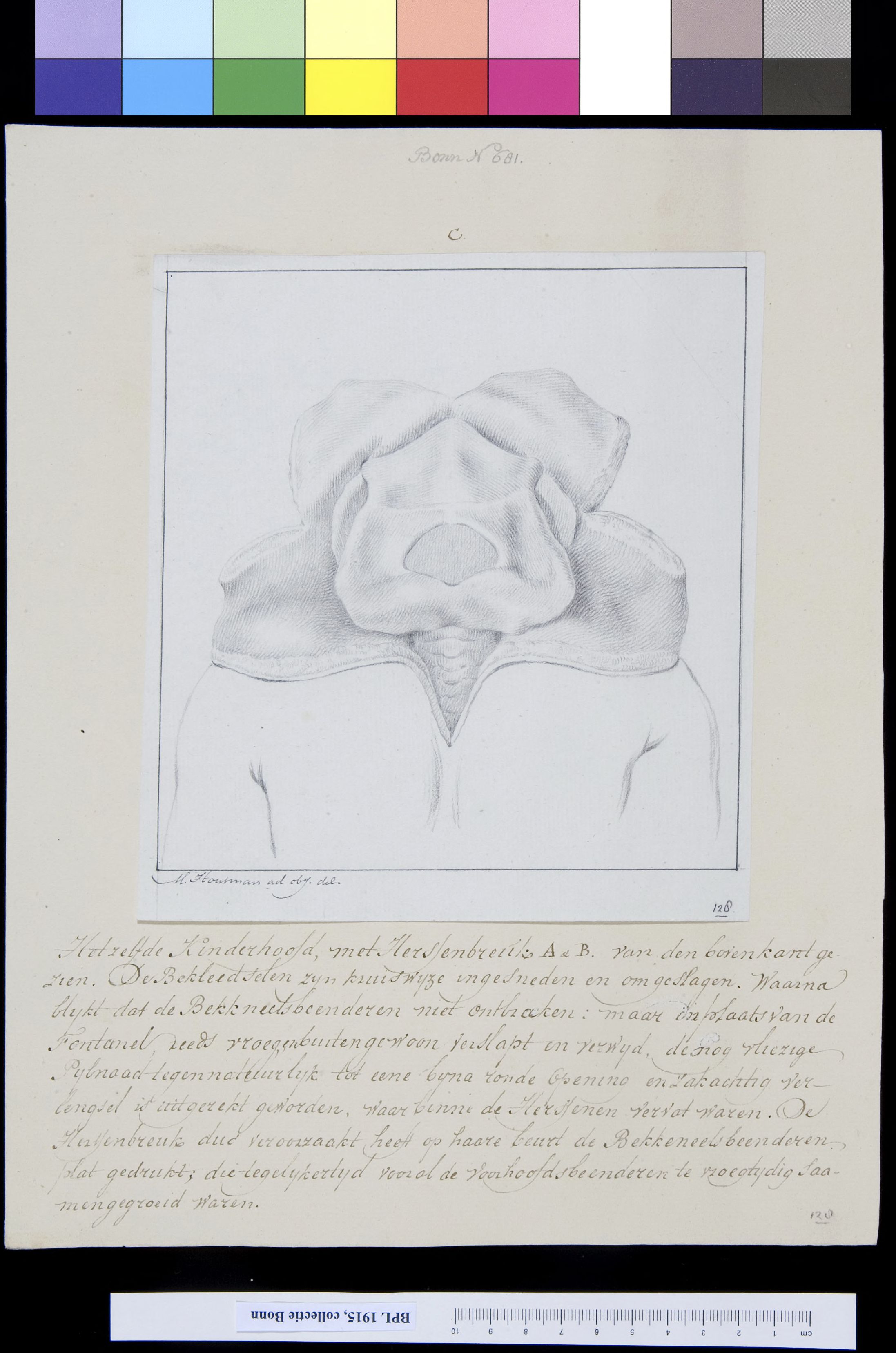 Deformed child, with fractured skull