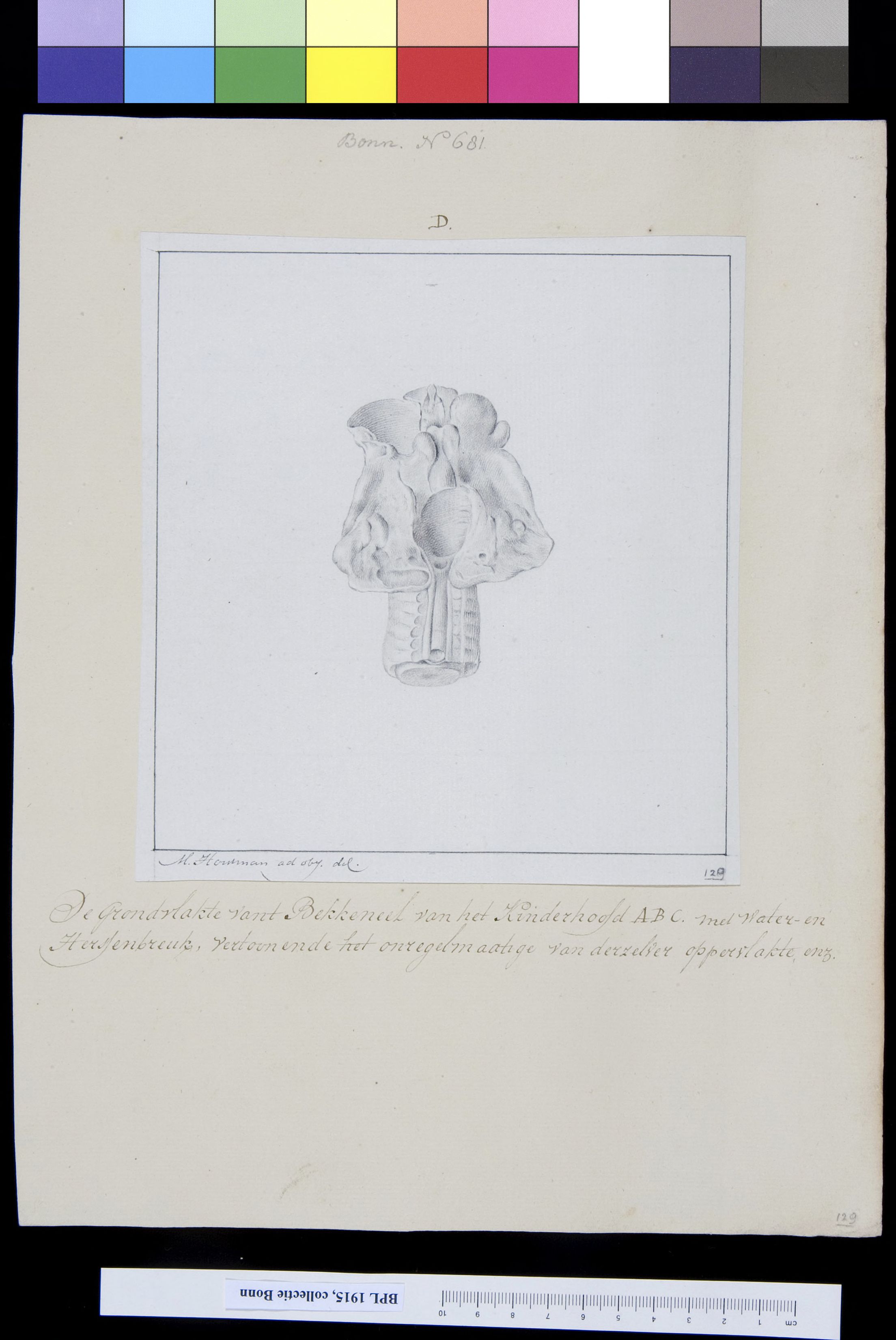 Skull fragment of deformed child