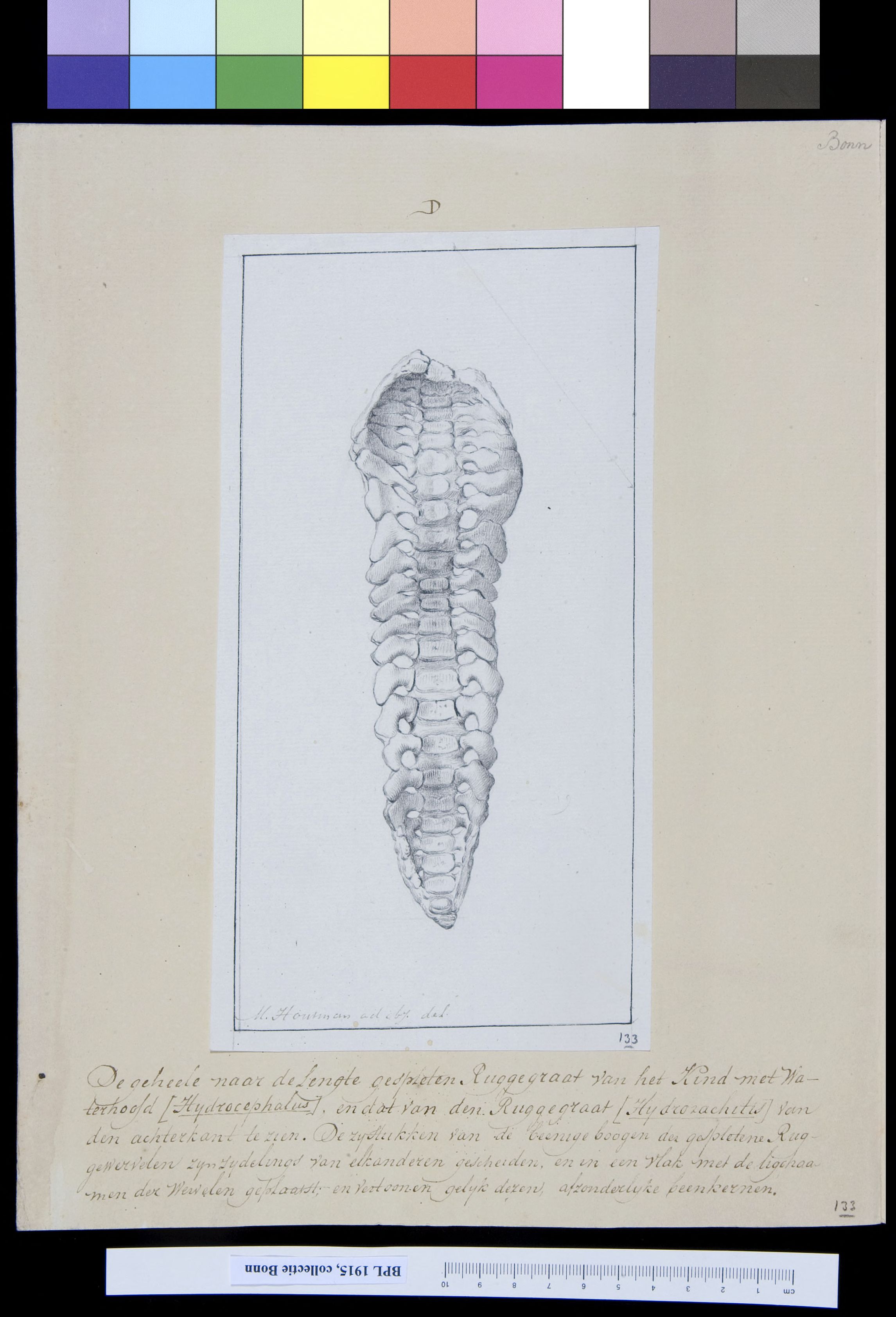 Vertebrae of child with hydrocephalus