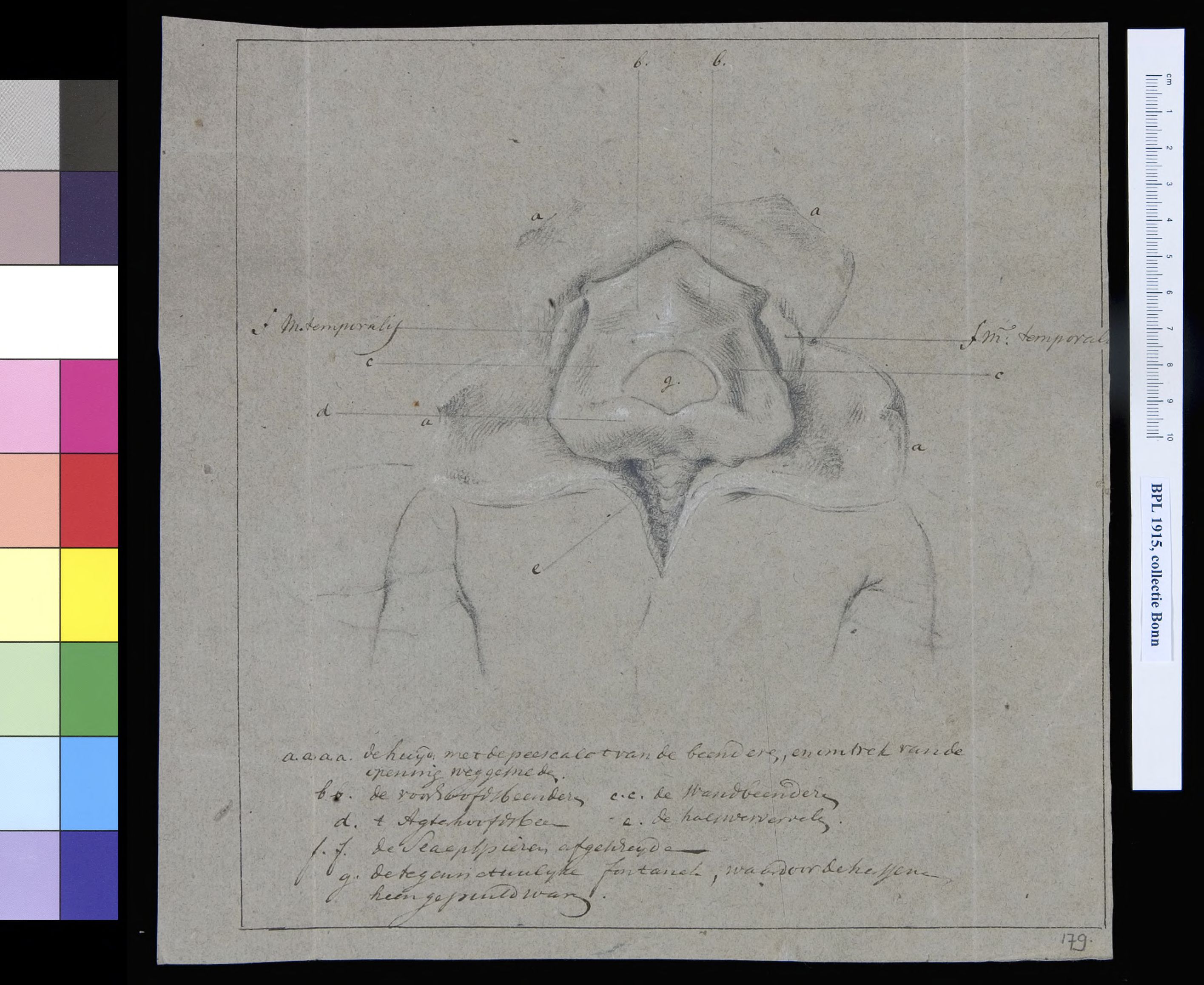 Deformed child, with fractured skull